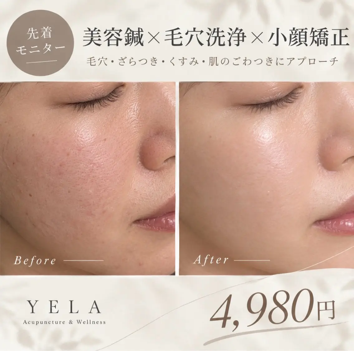 【先着モニター】美容鍼×毛穴洗浄×小顔矯正 4,980円の写真