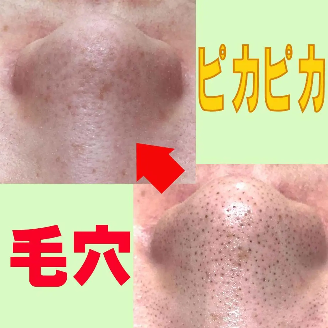 【毛穴の黒ずみにお悩みの方限定】エレクトロ特殊洗浄毛穴ブラシ使用☆肌診断機付✨の写真