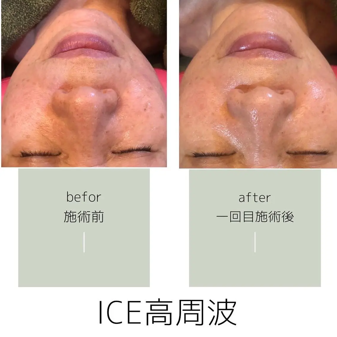 高周波ICE フェイシャルの写真