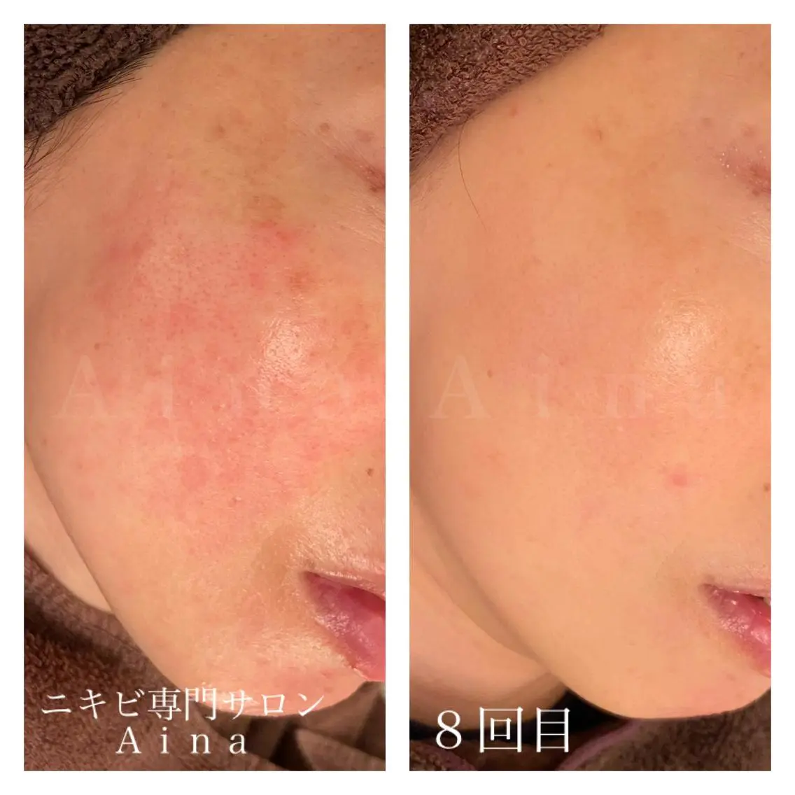 セミロング カラー パーマ ヘアアレンジ メンズ キッズ ネイル マツエク・マツパ 赤色 ニキビ跡専門サロン Ａｉｎａのエステ・リラクイメージ