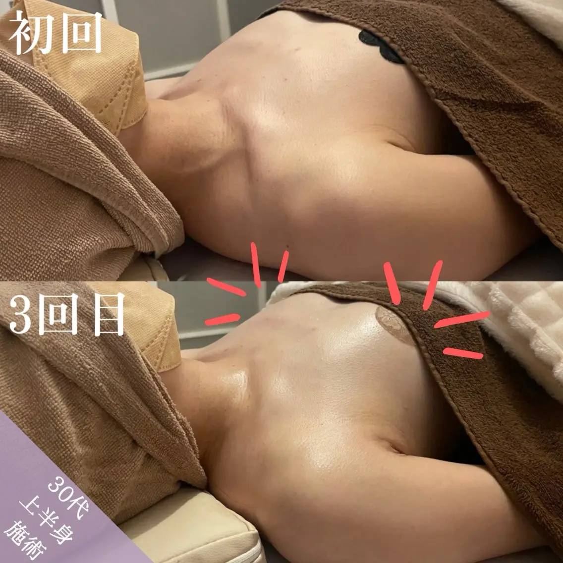 【先着3名様のみ!】半額で3回施術を受けれる"上半身"バストモニター様♪の写真
