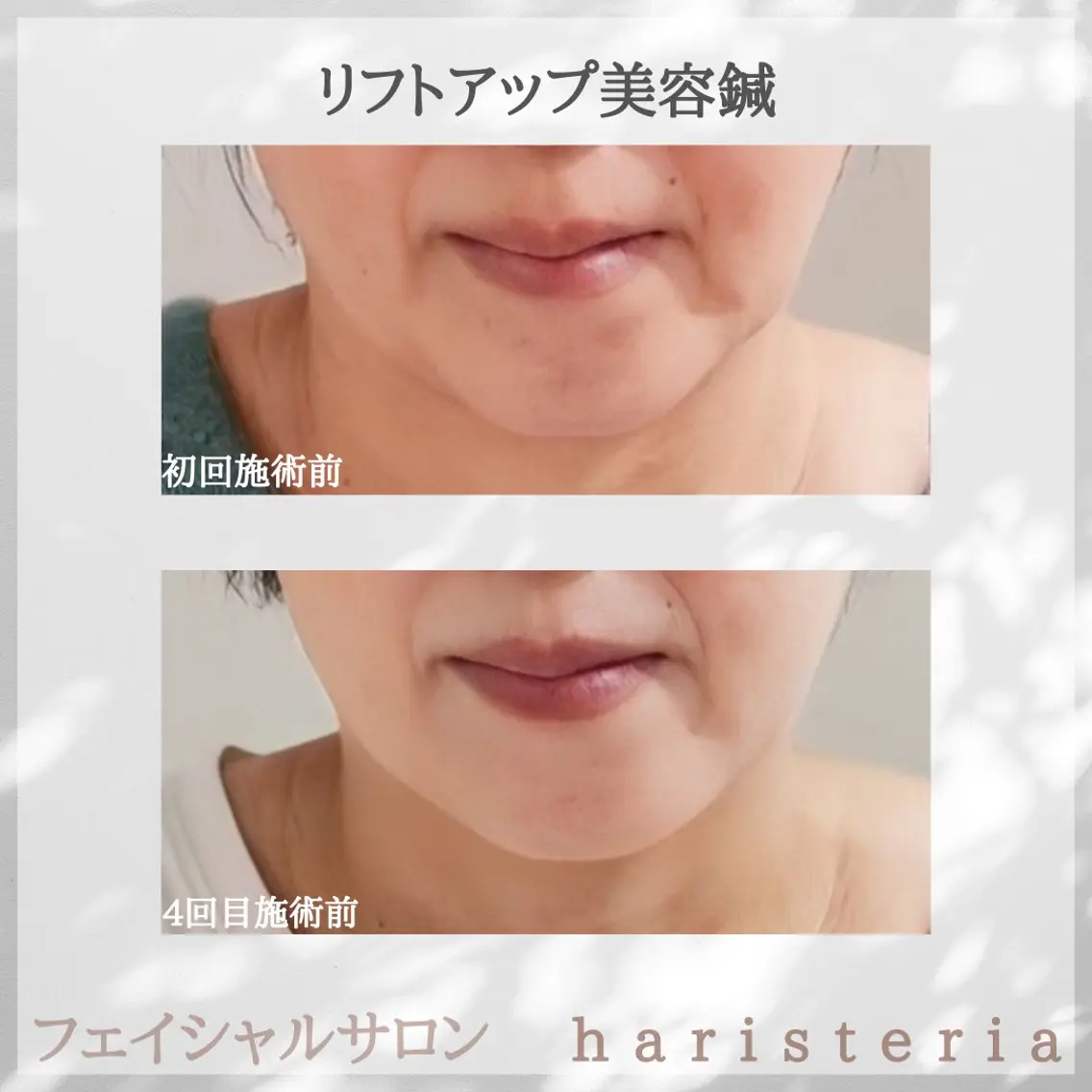 美容鍼と美肌専門 ハリステリアのエステ・リラクイメージ