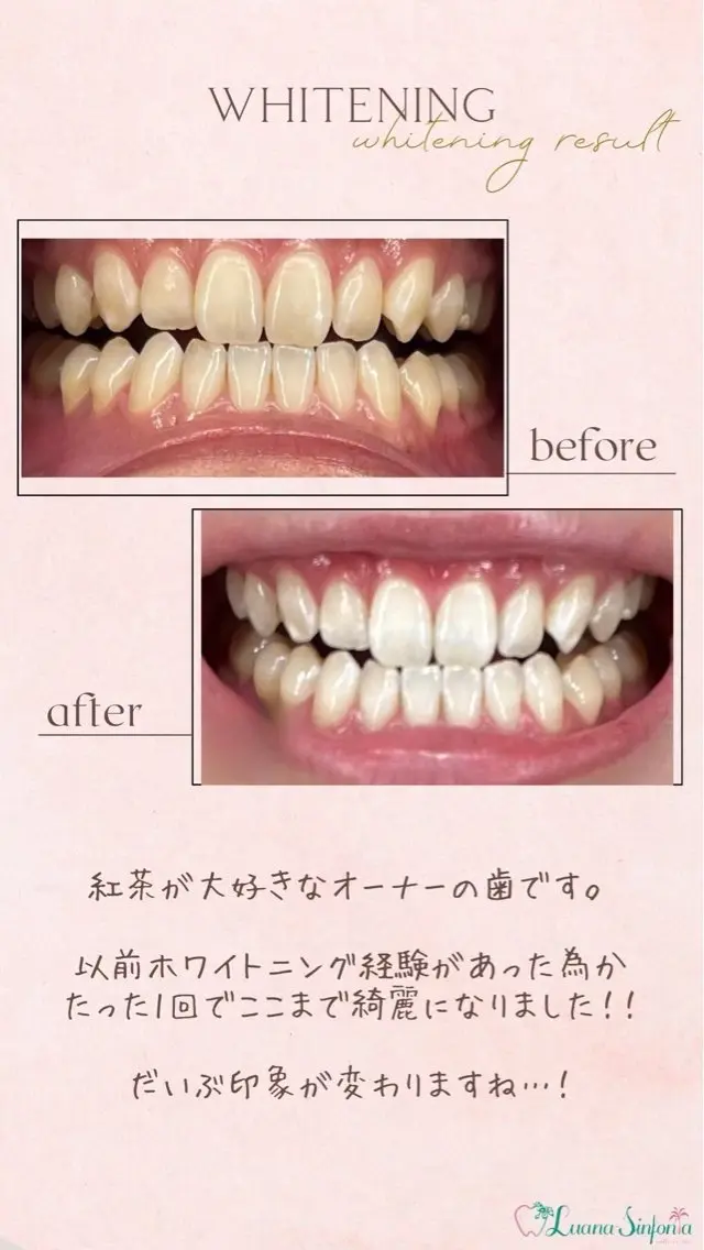セルフホワイトニング Yuaのその他イメージ