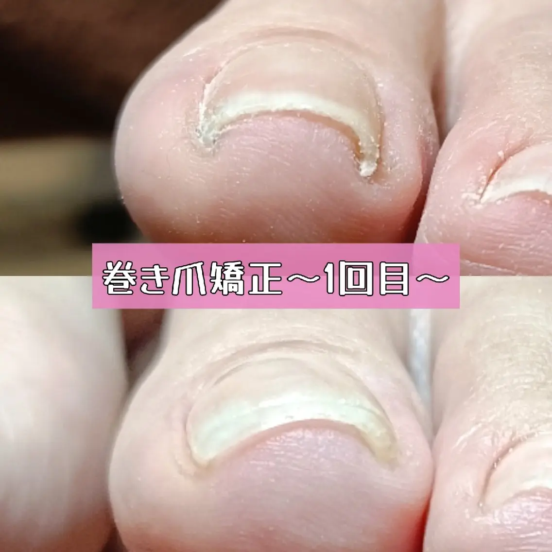Foot【親指の巻き爪矯正】上質ケア×美フォルムジェルコースの写真