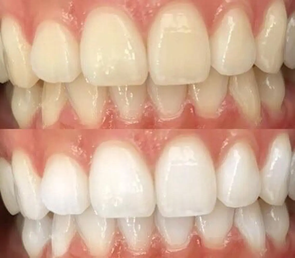 🦷【しっかり白く】プラチナホワイトニングの写真