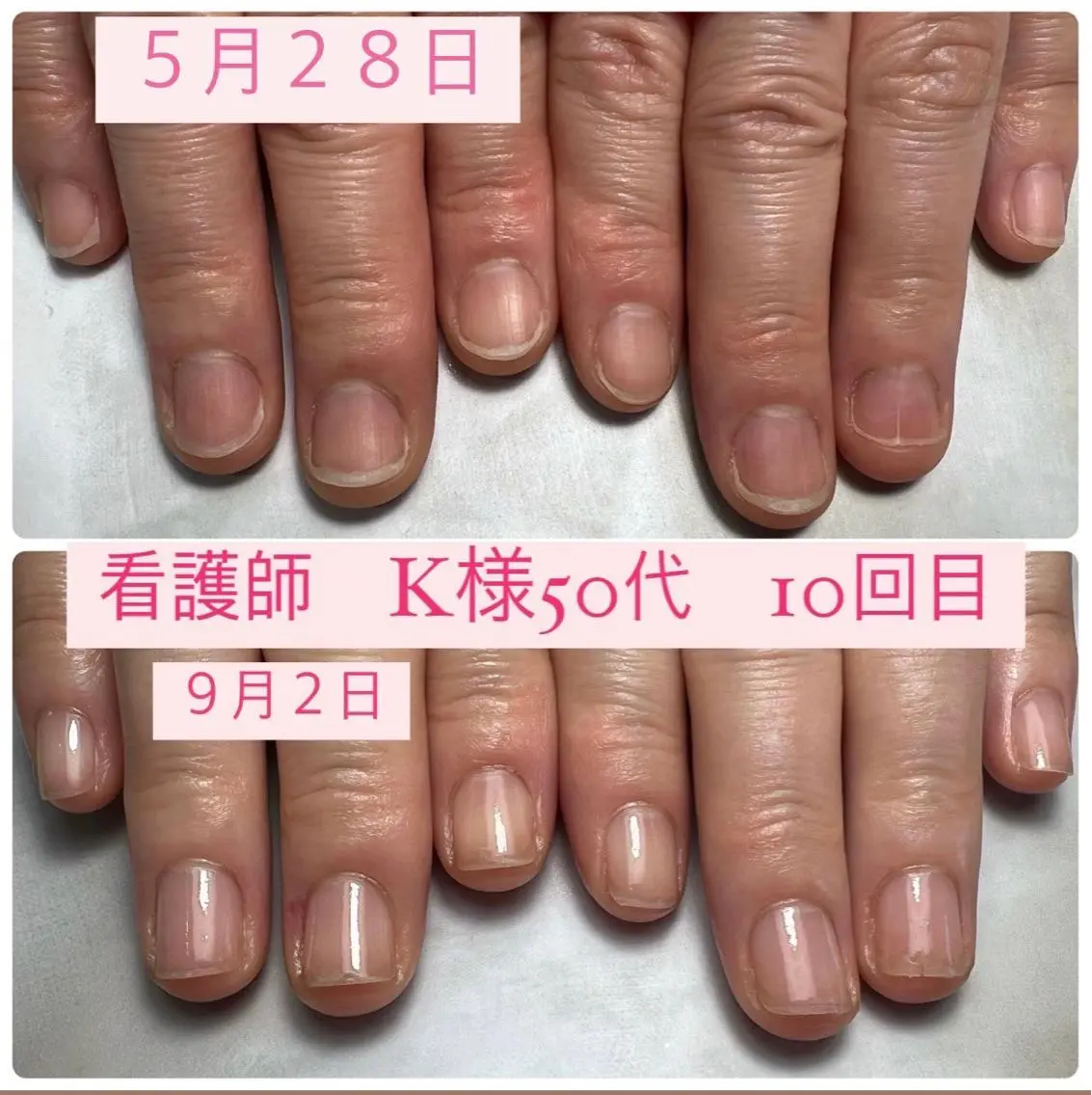 ネイル 自爪育成/深爪矯正 mikiのネイルデザイン