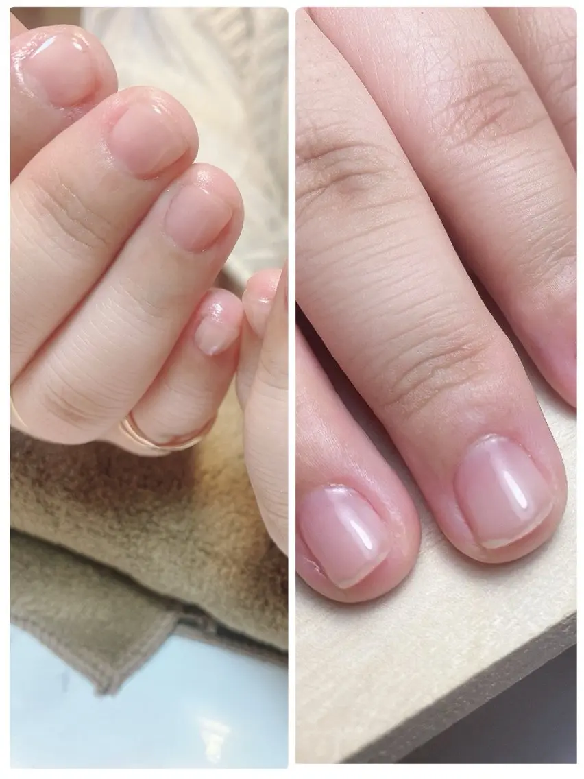 自爪育成ケアの写真