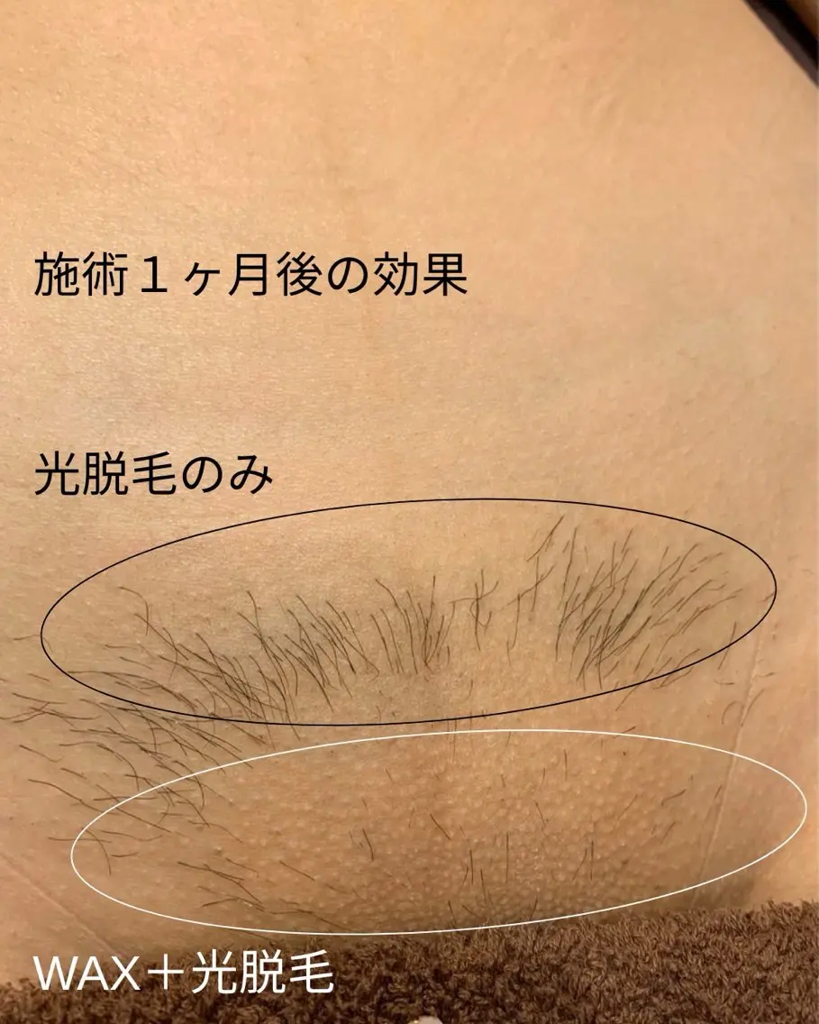 脱毛 HANAKO 山下のエステ・リラクイメージ