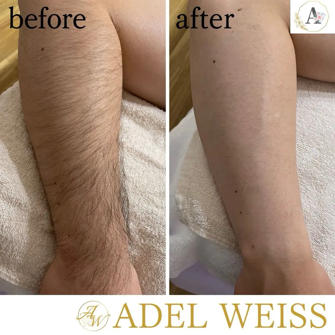 脱毛 ADEL WEISS 脱毛&毛穴&リンパのその他イメージ
