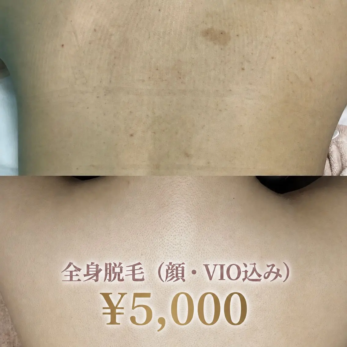 【限定クーポン⭐︎】人気No1👑全身脱毛(顔・VIO込み)¥5,000の写真