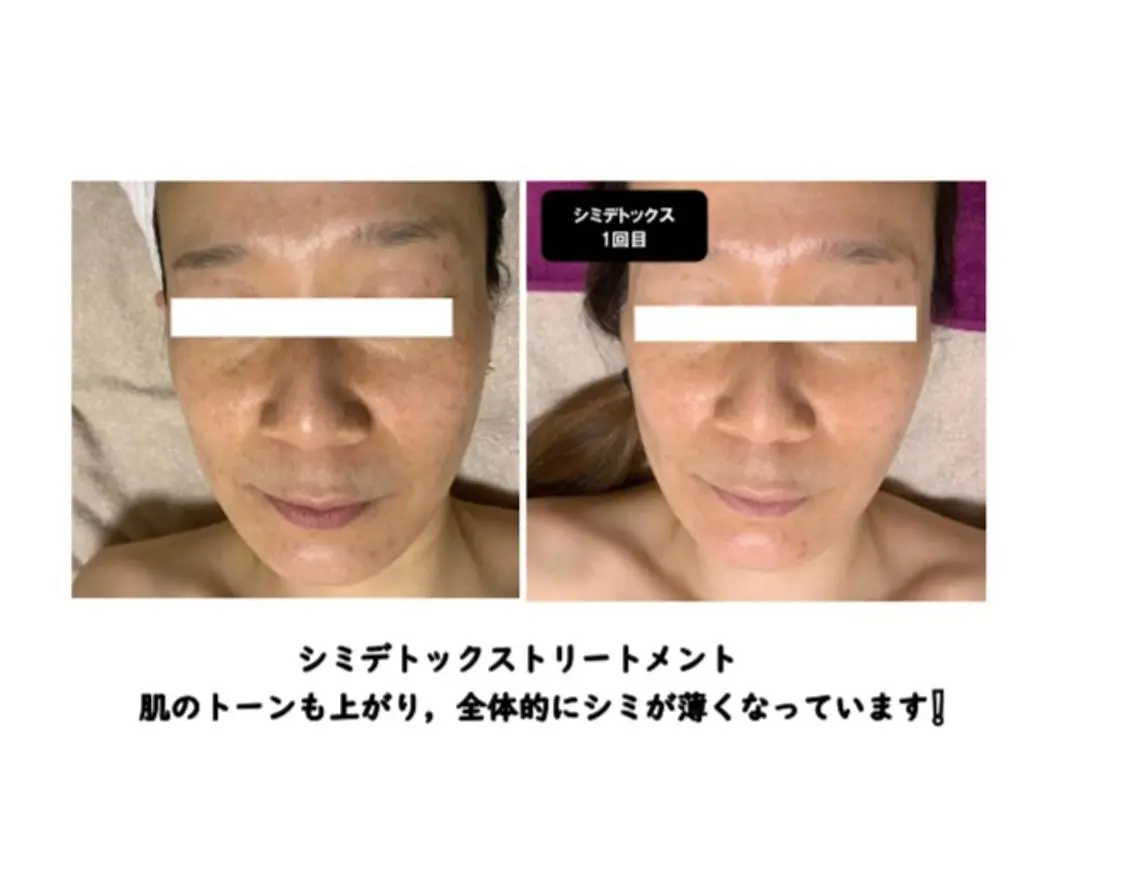 シミデトックストリートメント✨初回限定　6,000円✨の写真