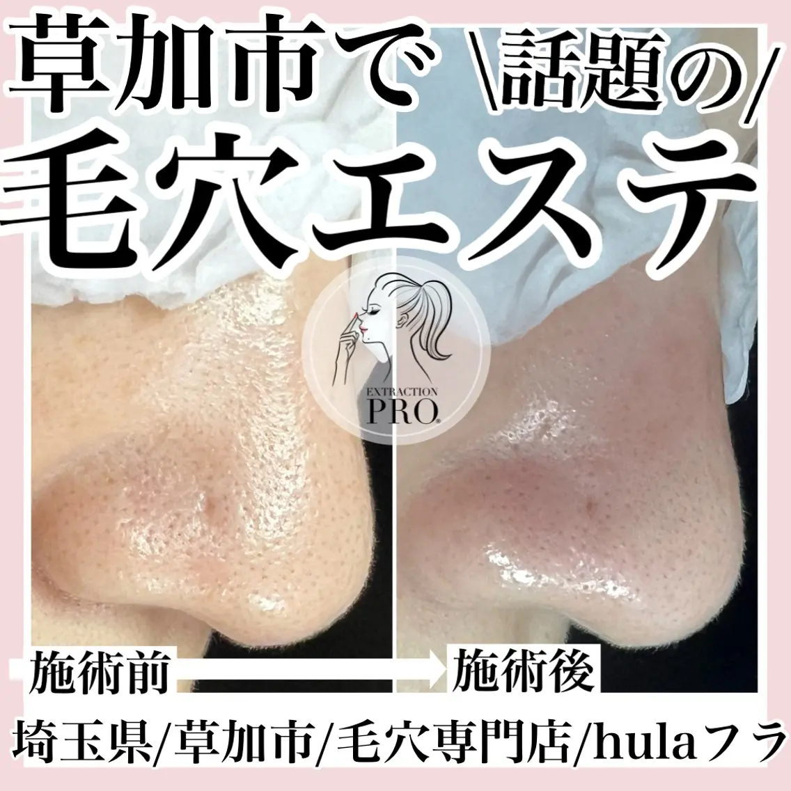 毛穴改善コース(毛穴エクストラクションプロ/毛穴洗浄のみ)マッサージは付きません。の写真