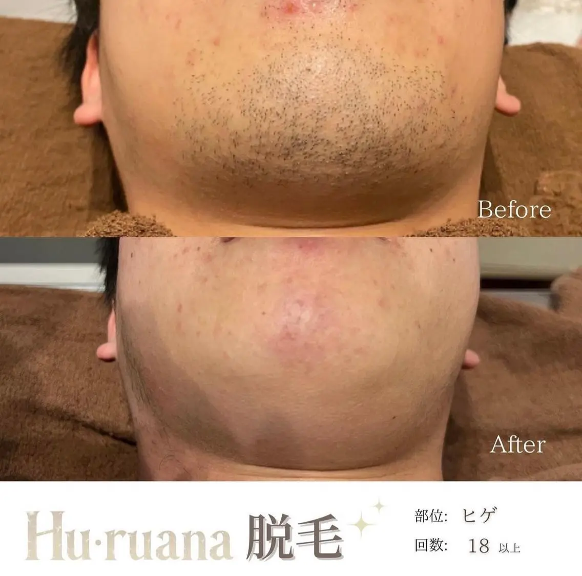 脱毛 Hu.ruana AWANOのエステ・リラクイメージ