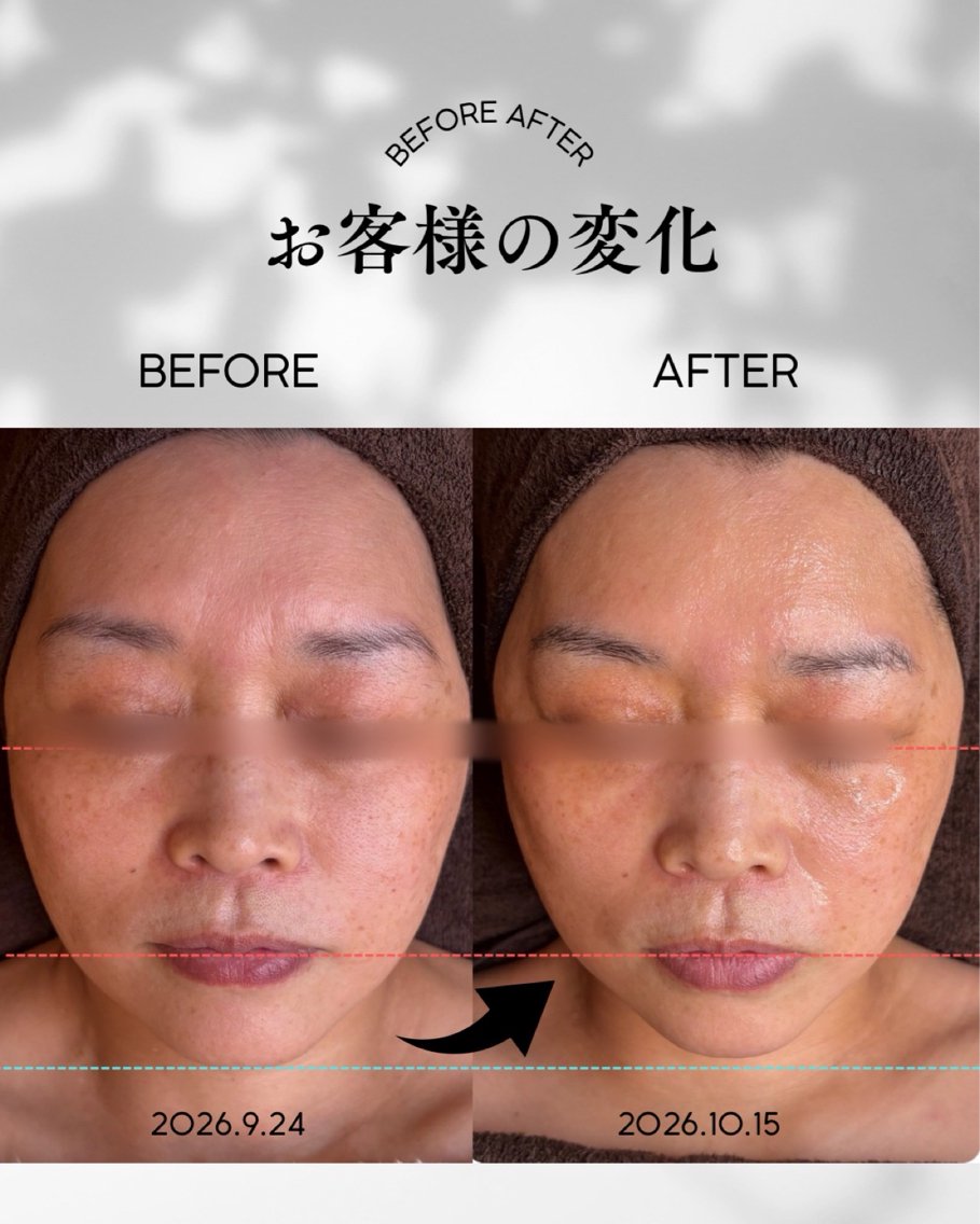 【⏰スキマ時間でご褒美ケア💆♀️】ハイパーナイフフェイシャル(60分)✨ ふっくらハリ肌ケアの写真