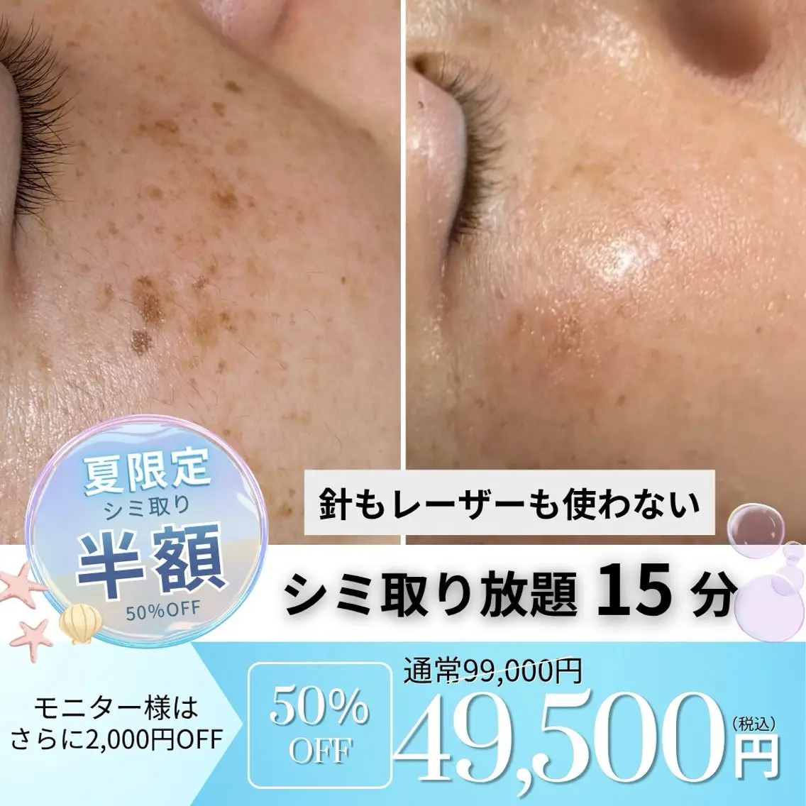 💎シミ取り放題15分の写真