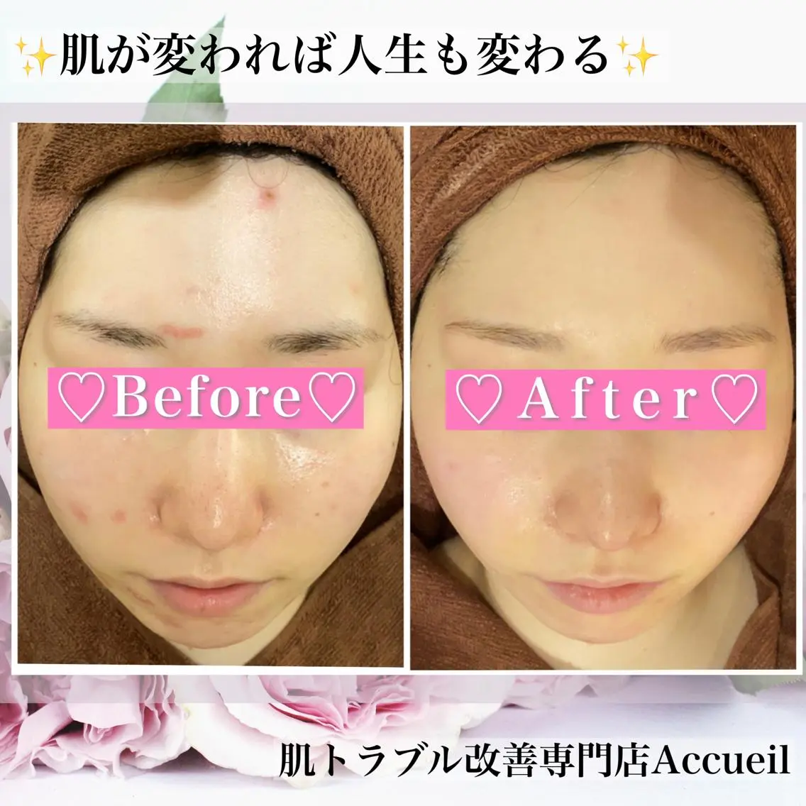 ミディアム カラー パーマ ヘアアレンジ メンズ キッズ ネイル マツエク・マツパ アイブロウ エステ リラク ニキビ・肌質改善専門 ♡人生が変わるサロンのエステ・リラクイメージ