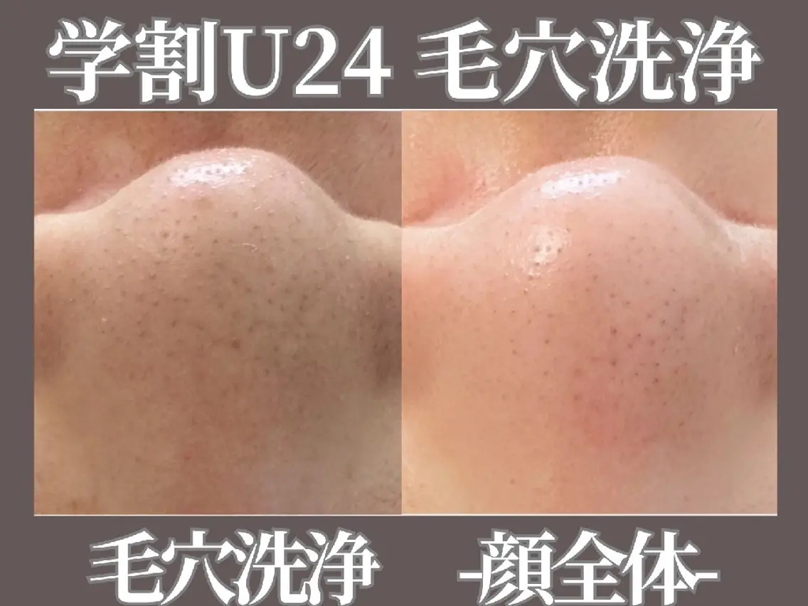 【学割U24】学生限定　黒ずみ角栓ごっそり　毛穴洗浄（顔全体）の写真