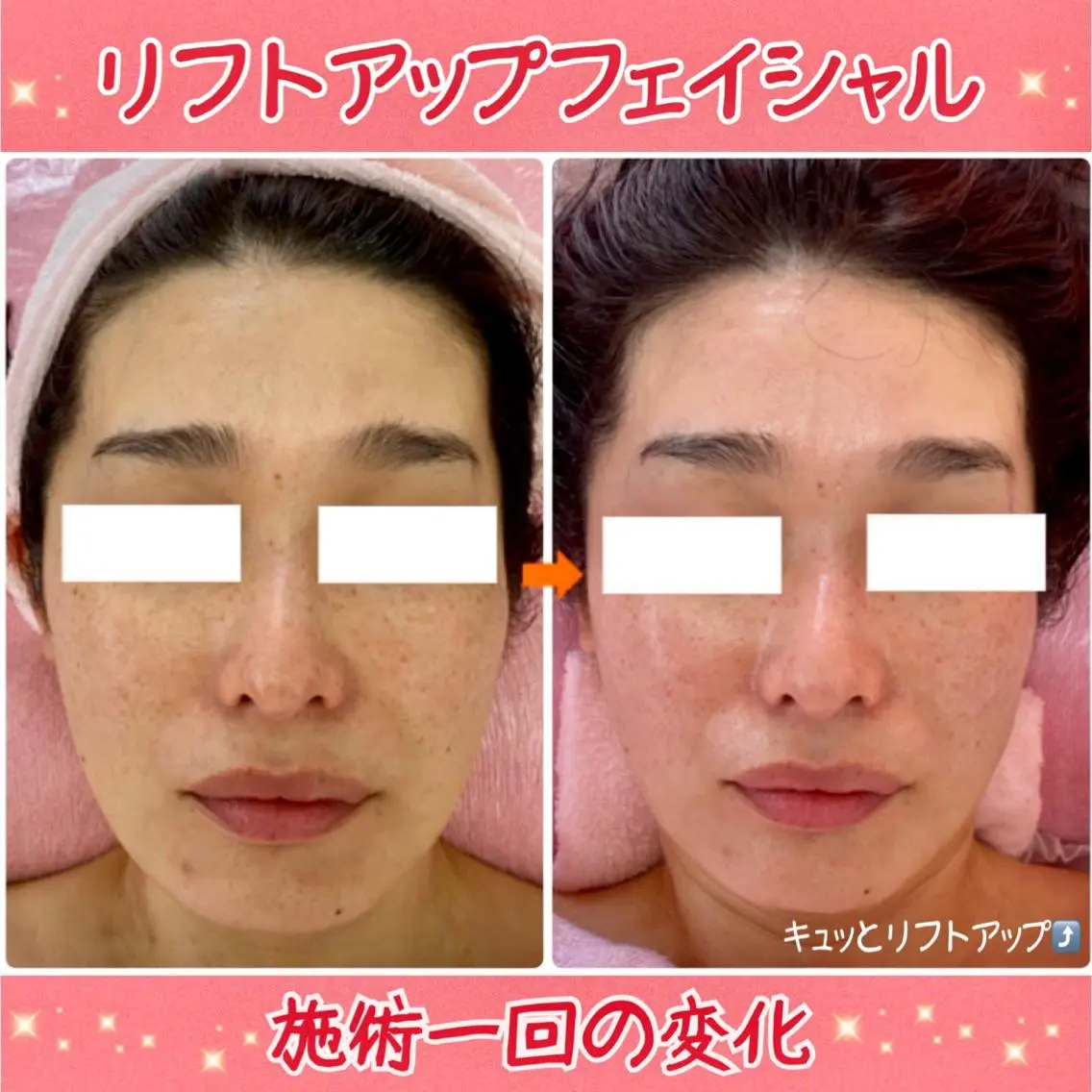 【新規】ほうれい線、たるみに◎ウルトラ筋膜リリース＆リフトアップフェイシャル💆‍♀️(60分)の写真
