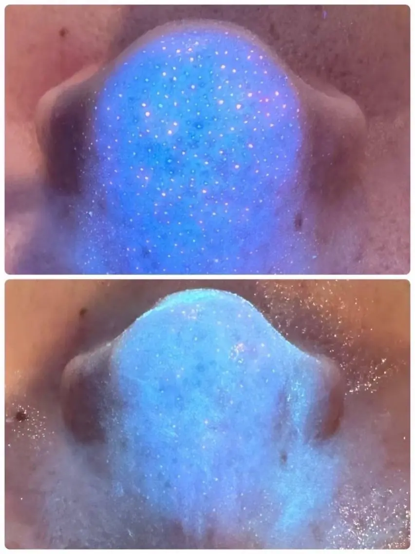 【毛穴・ザラつきオフ】ハイドラ毛穴洗浄✨の写真