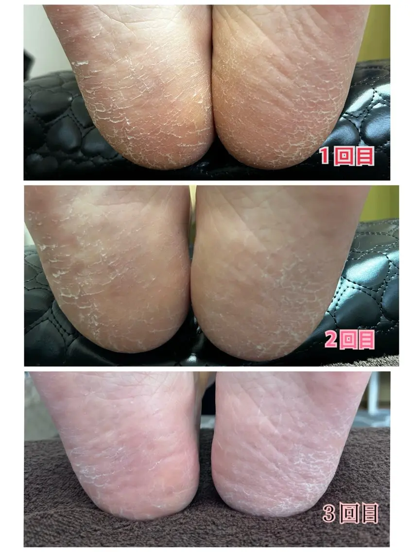 フットケア（爪の形を整え、甘皮ケア、足裏の硬くなった角質ケア）の写真