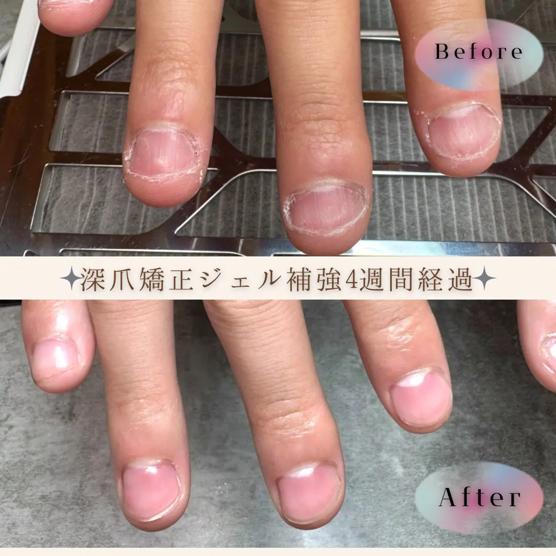 自爪.深爪育成ジェルの写真