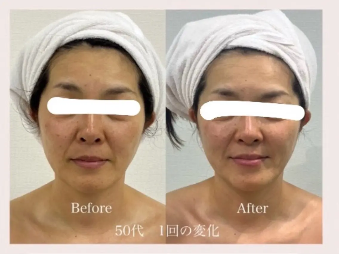 FACE MAKER【最新リフトアップ&肌改善】初回限定特別価格　(小顔/たるみ)💆‍♀️の写真