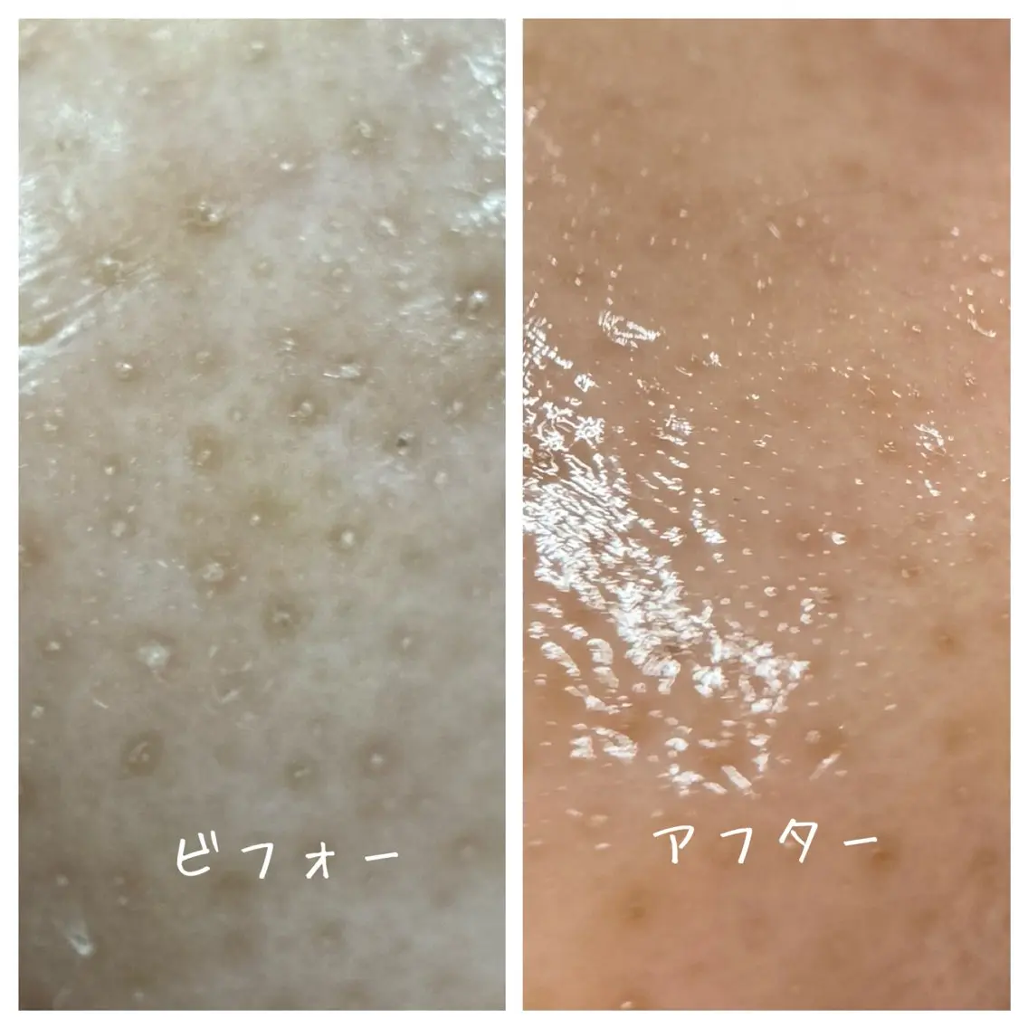 大人気!毛穴の大掃除🧹ピーリングで小鼻つるつるに✨お肌のキメを整えてさらに美肌へ!小鼻ピーリング+超音波エステの写真