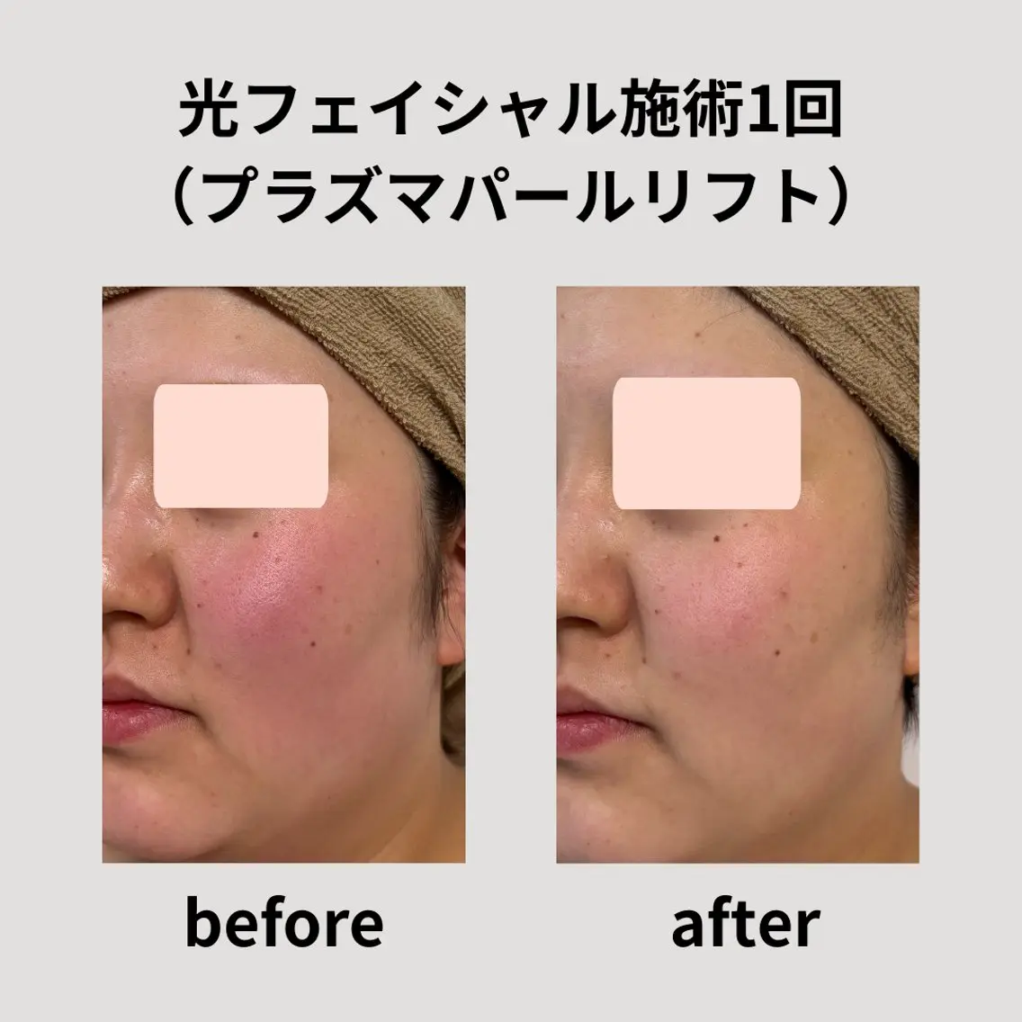 脱毛 脱毛&フェイシャル H'euriaのエステ・リラクイメージ