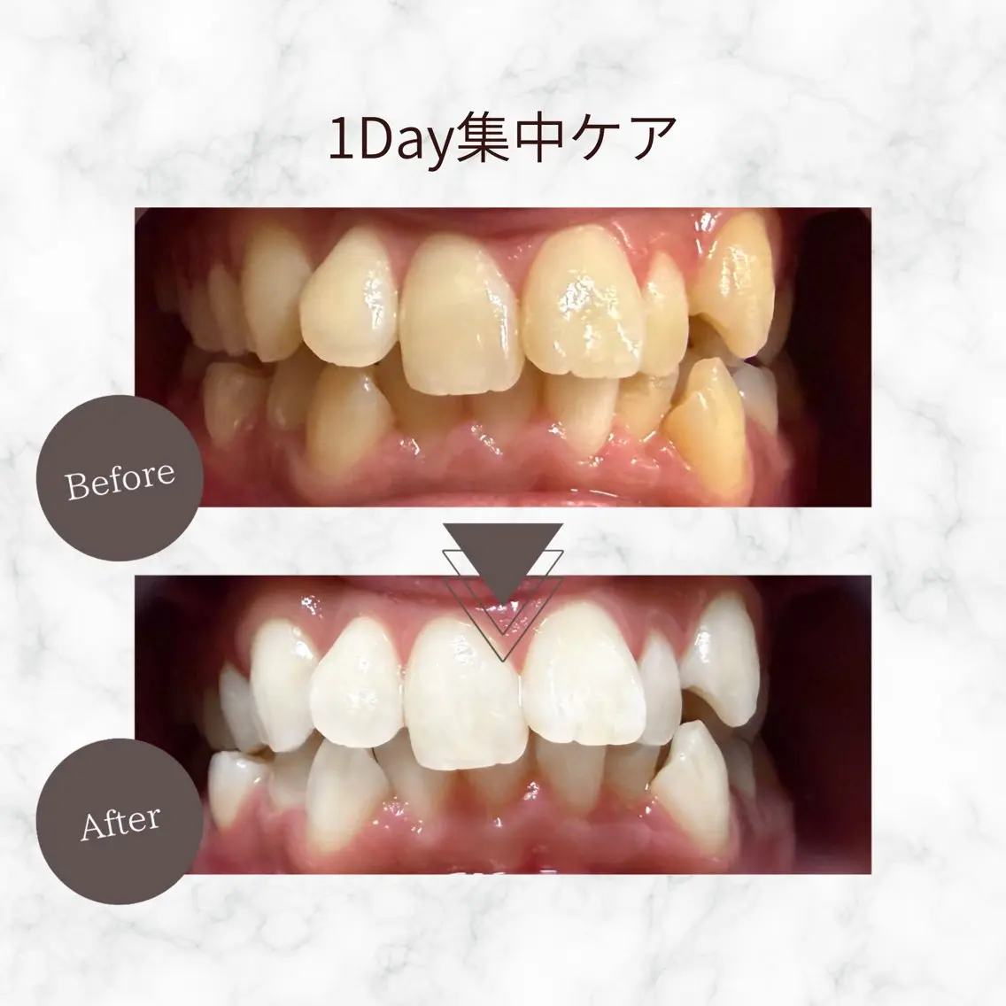 【最短で白くしたい方】1Day集中ケアホワイトニング 9分×6回照射の写真