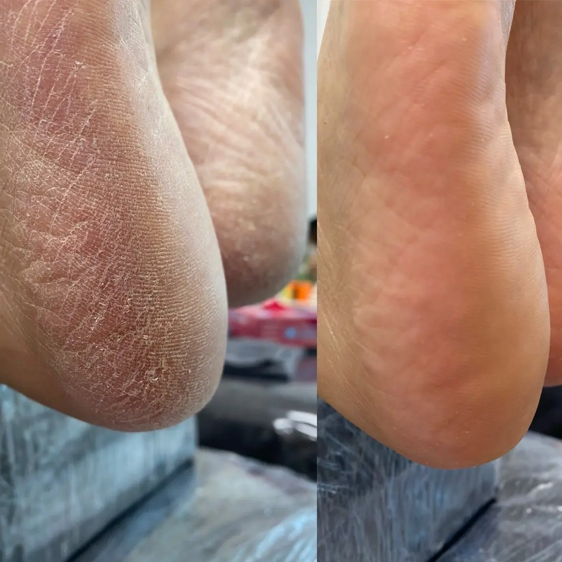 柔らか赤ちゃん足に🦶✨【足裏角質除去　90分　¥8,900】の写真