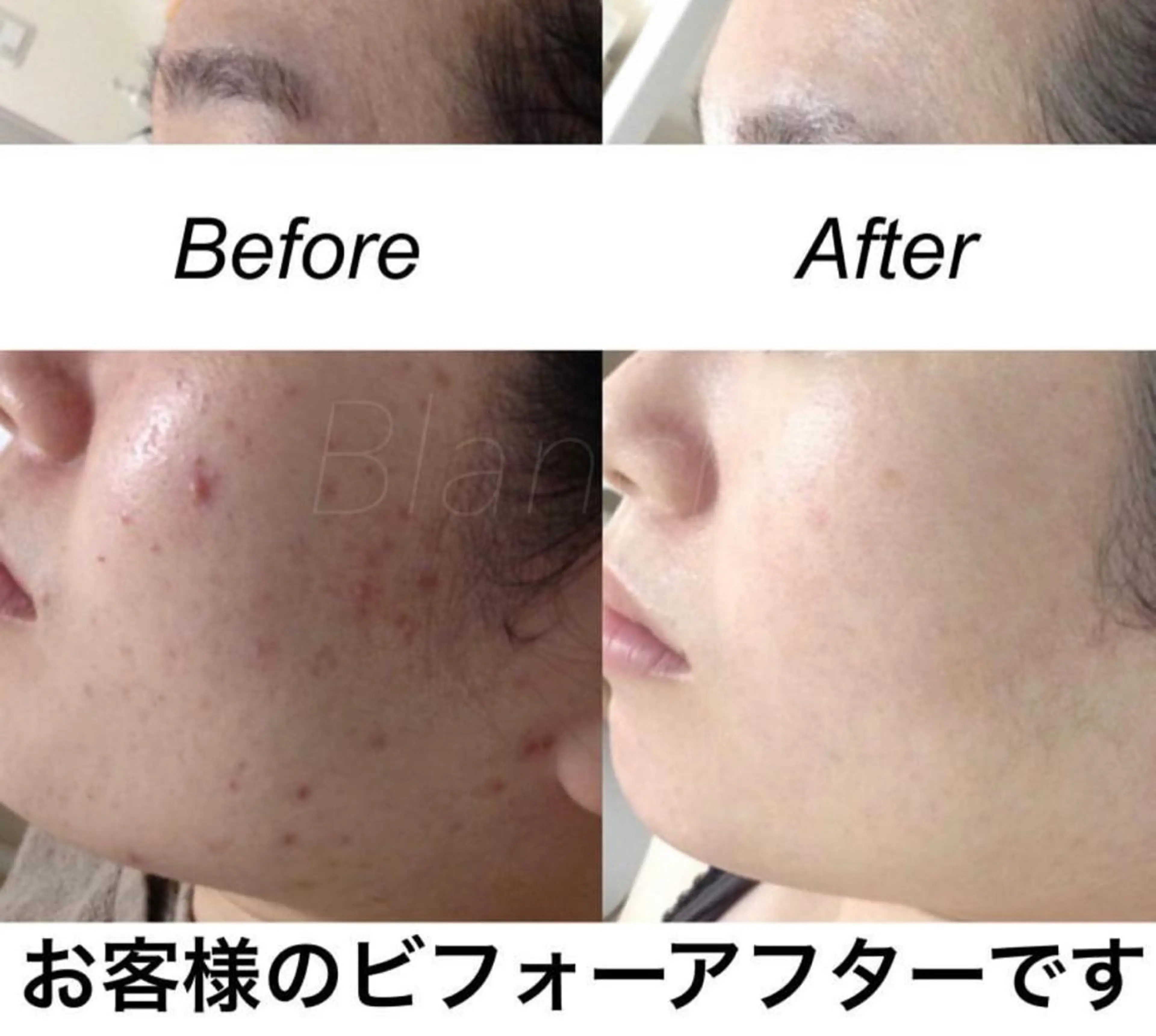 ロング パーマ ヘアアレンジ キッズ ネイル マツエク・マツパ エステ リラク 都度払い肌質改善 &脱毛Blancheのエステ・リラクイメージ