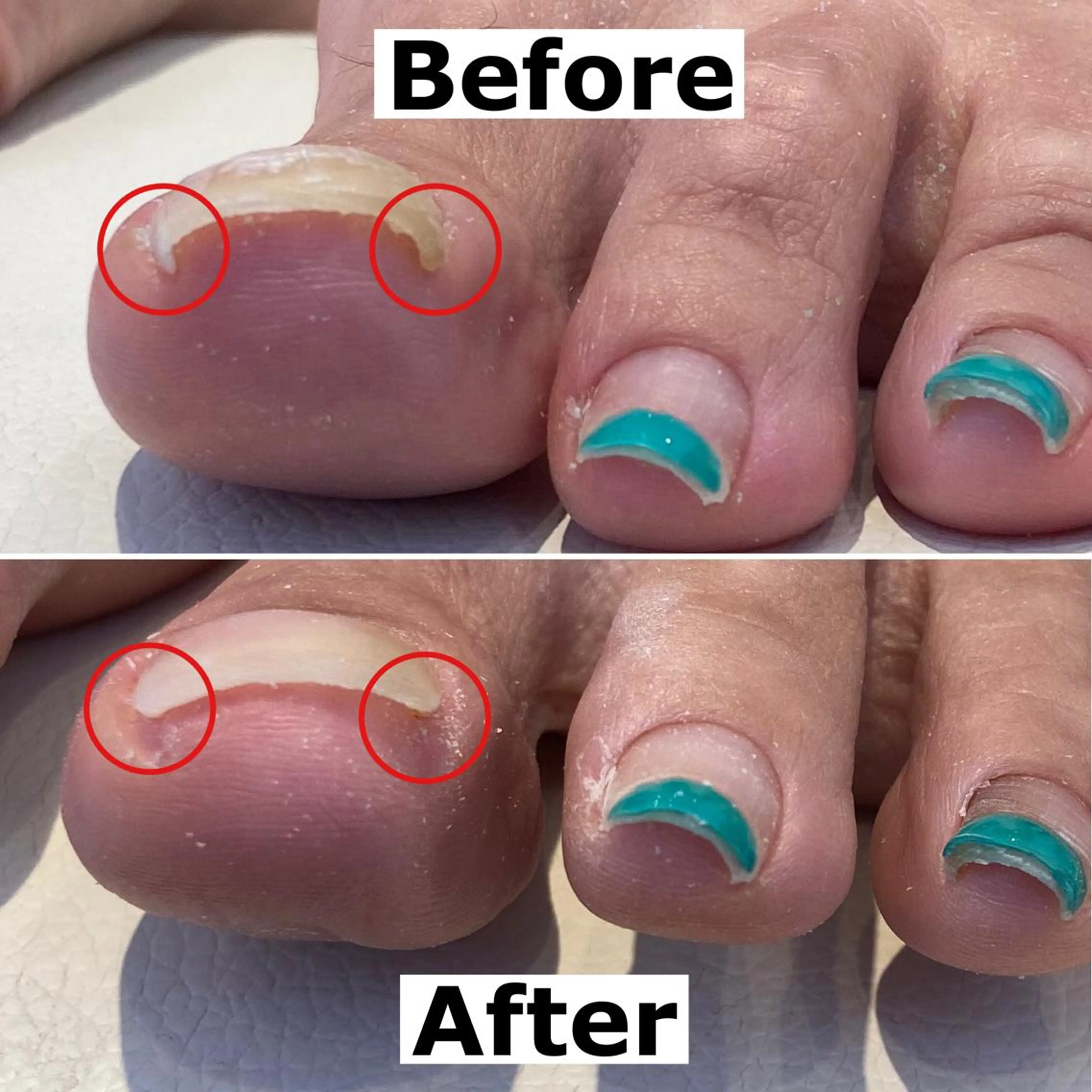 ネイル 巻爪無料モデル募集 ✨🦶MEGUMIのネイルデザイン