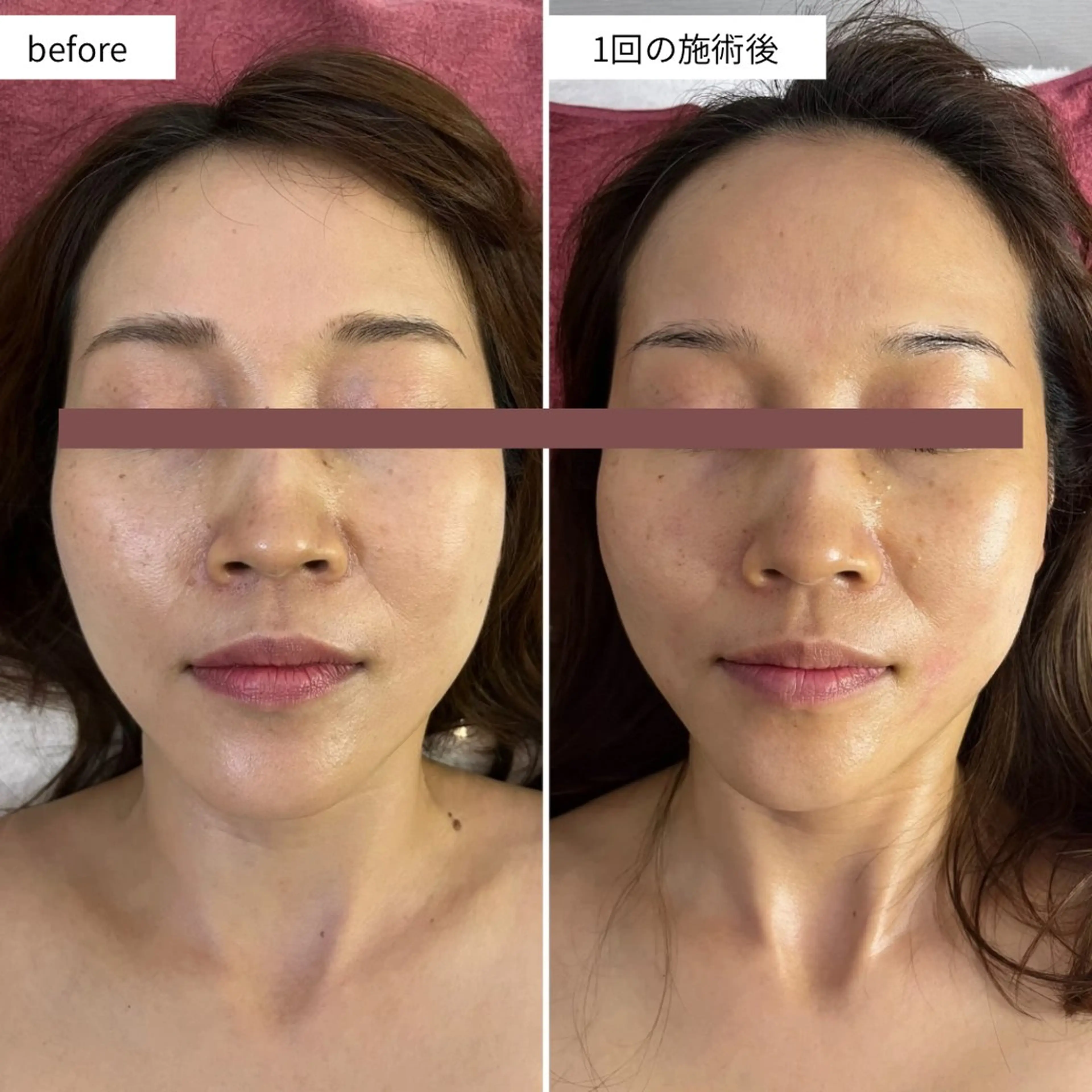 エステ シミ・毛穴ケア専門 クロヌYUKIのエステ・リラクイメージ