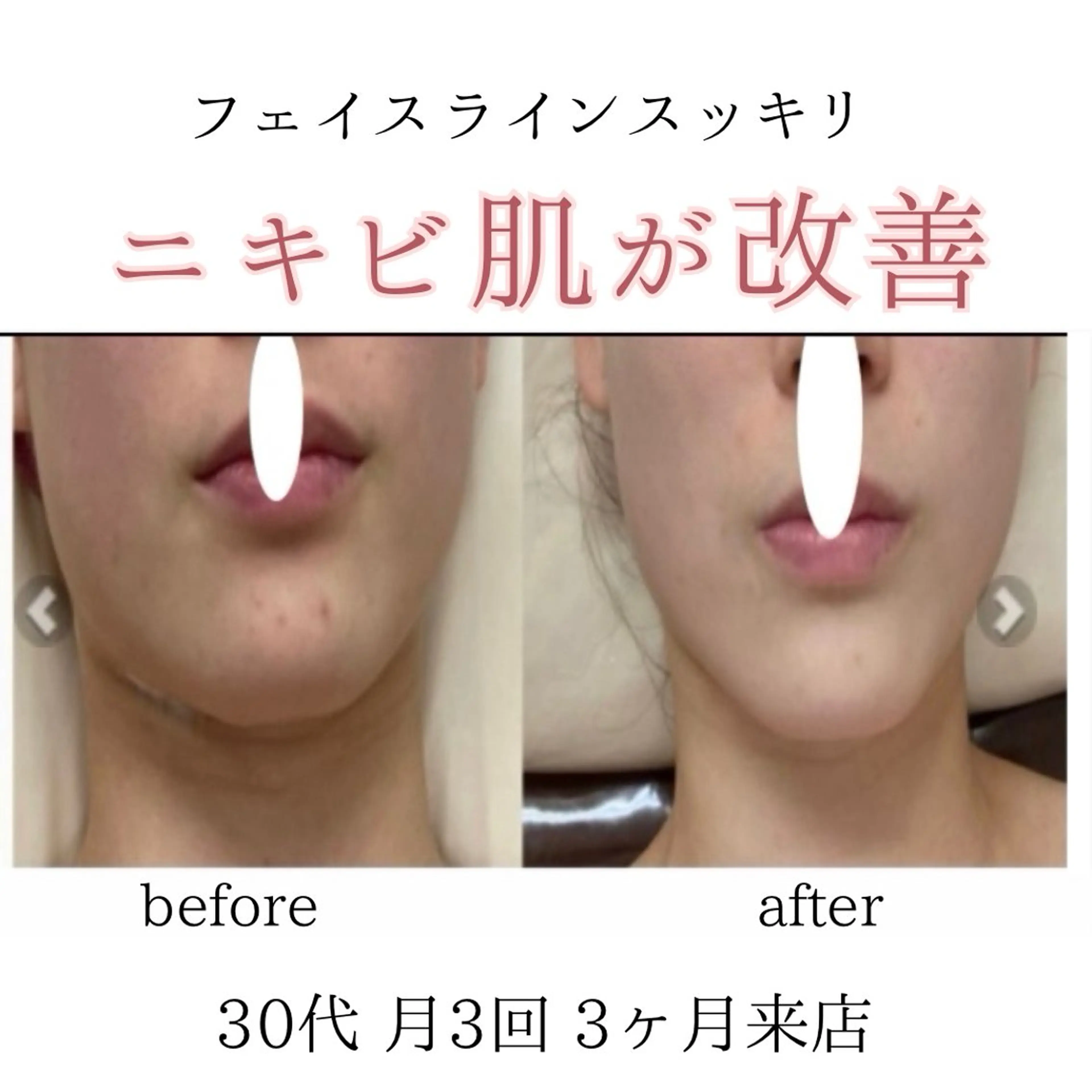 小顔・ニキビ ・脱毛サロンのエステ・リラクイメージ