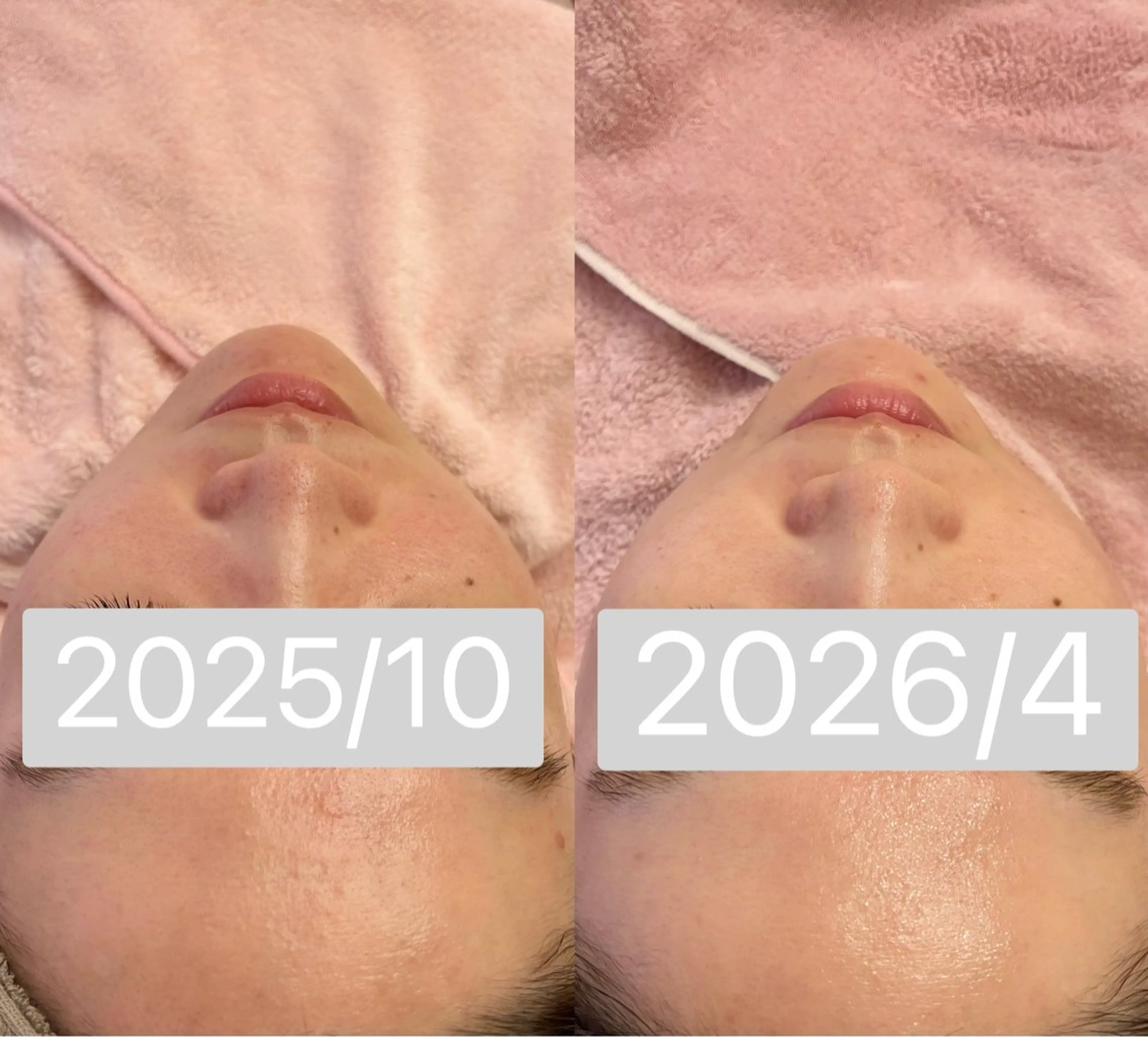 エステ 小顔&毛穴・肌質改善 LINDA西宮 AIのエステ・リラクイメージ