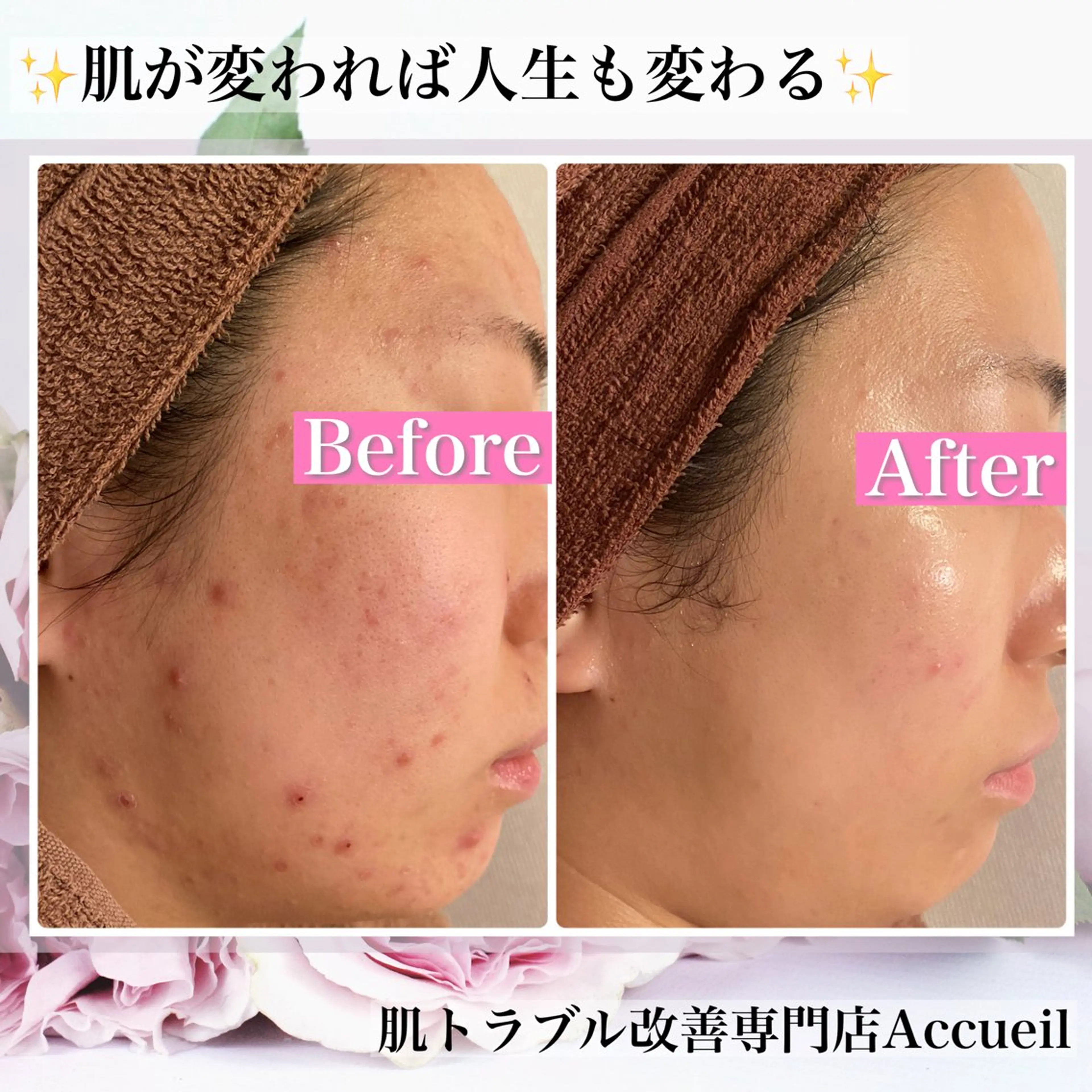 エステ リラク ニキビ・肌質改善専門 ♡人生が変わるサロンのエステ・リラクイメージ