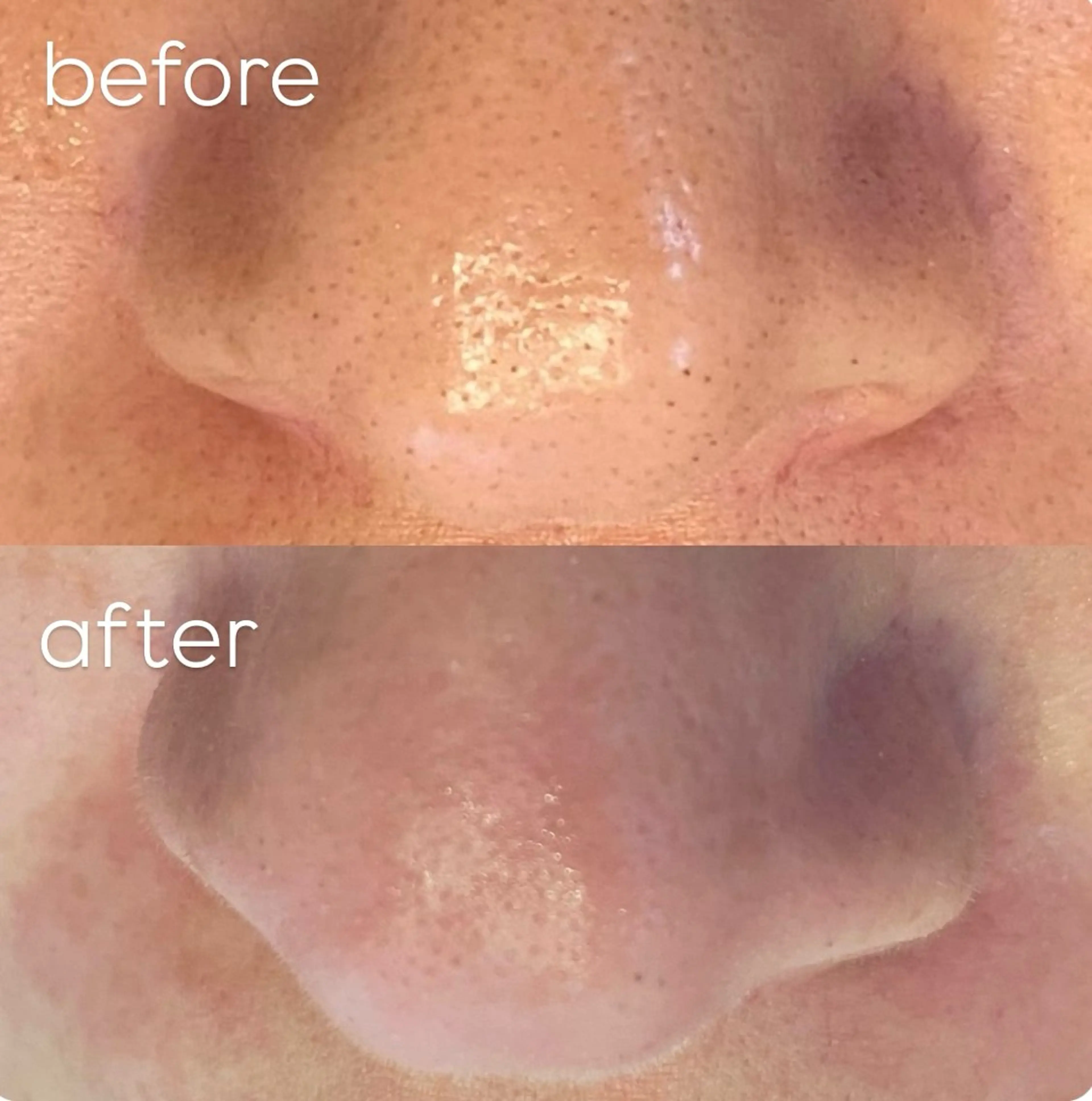 撮影モニターさん募集!吸引＋毛穴洗浄＋ヒト幹細胞ポレーション導入の写真