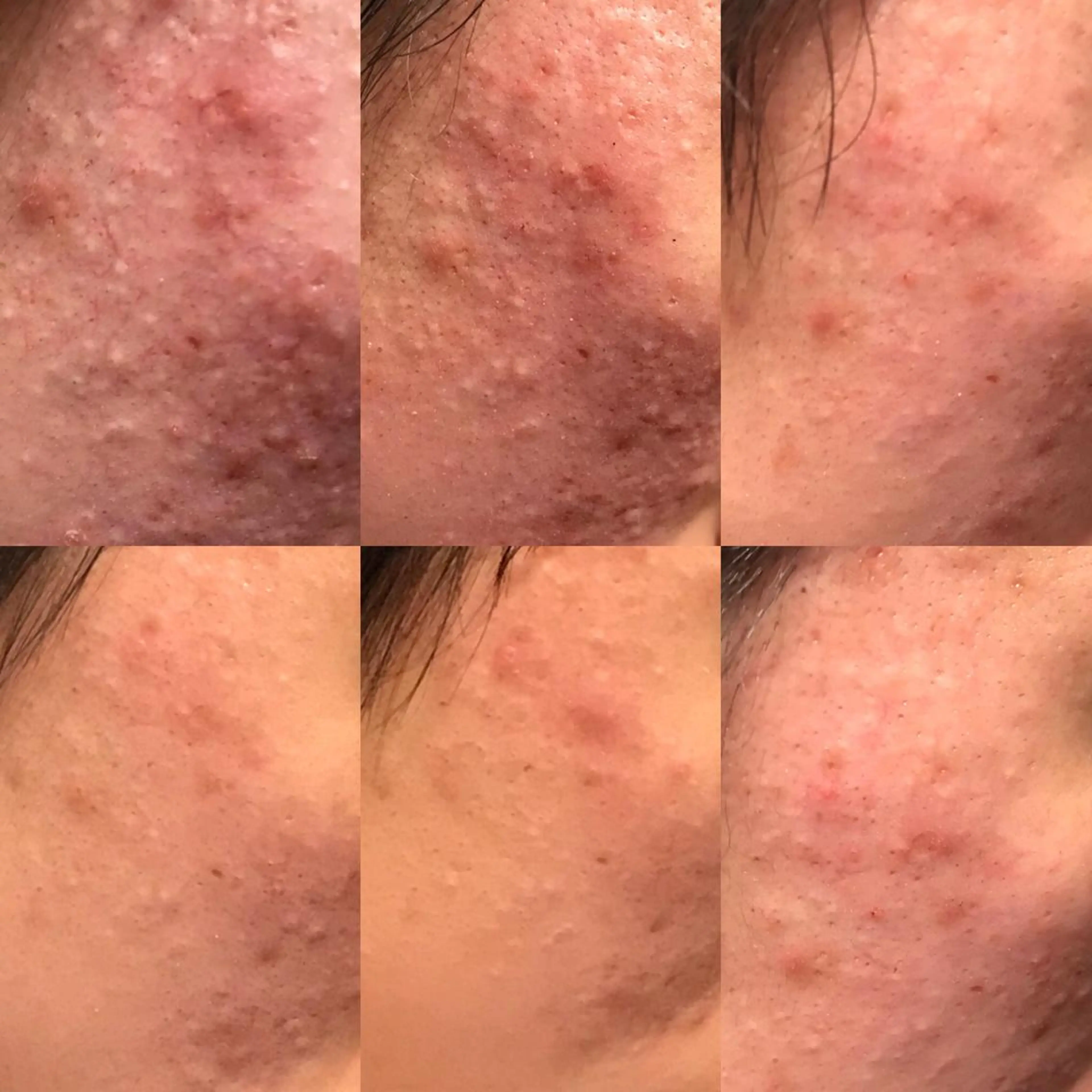 ニキビ&跡改善サロン オーナー光木のエステ・リラクイメージ