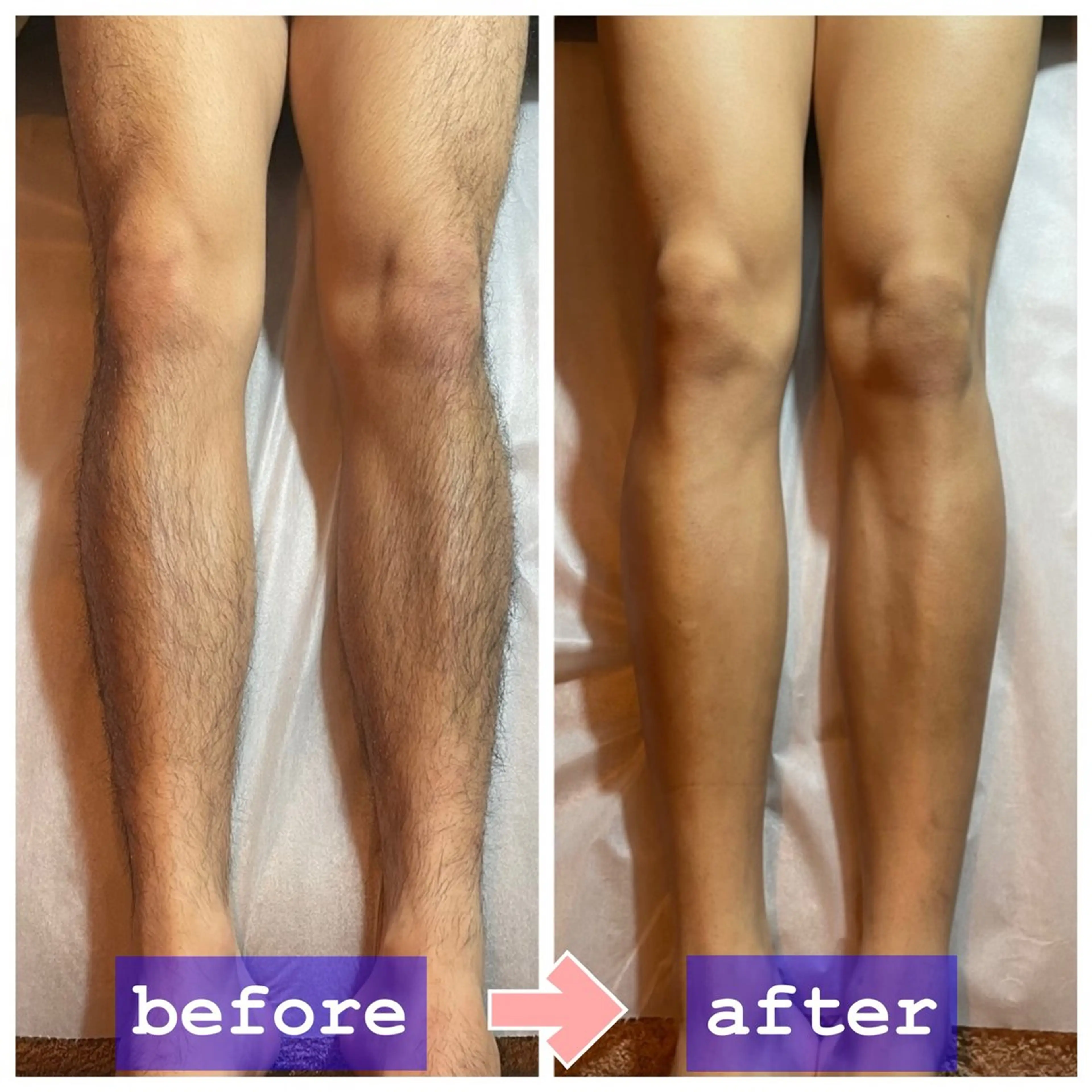 【✨️脚全体脱毛✨️】メンズ限定‼️太もも裏表/すね、ふくらはぎ/足の指甲/すべて含みます。3回まで同価格❕都度払い✨️の写真