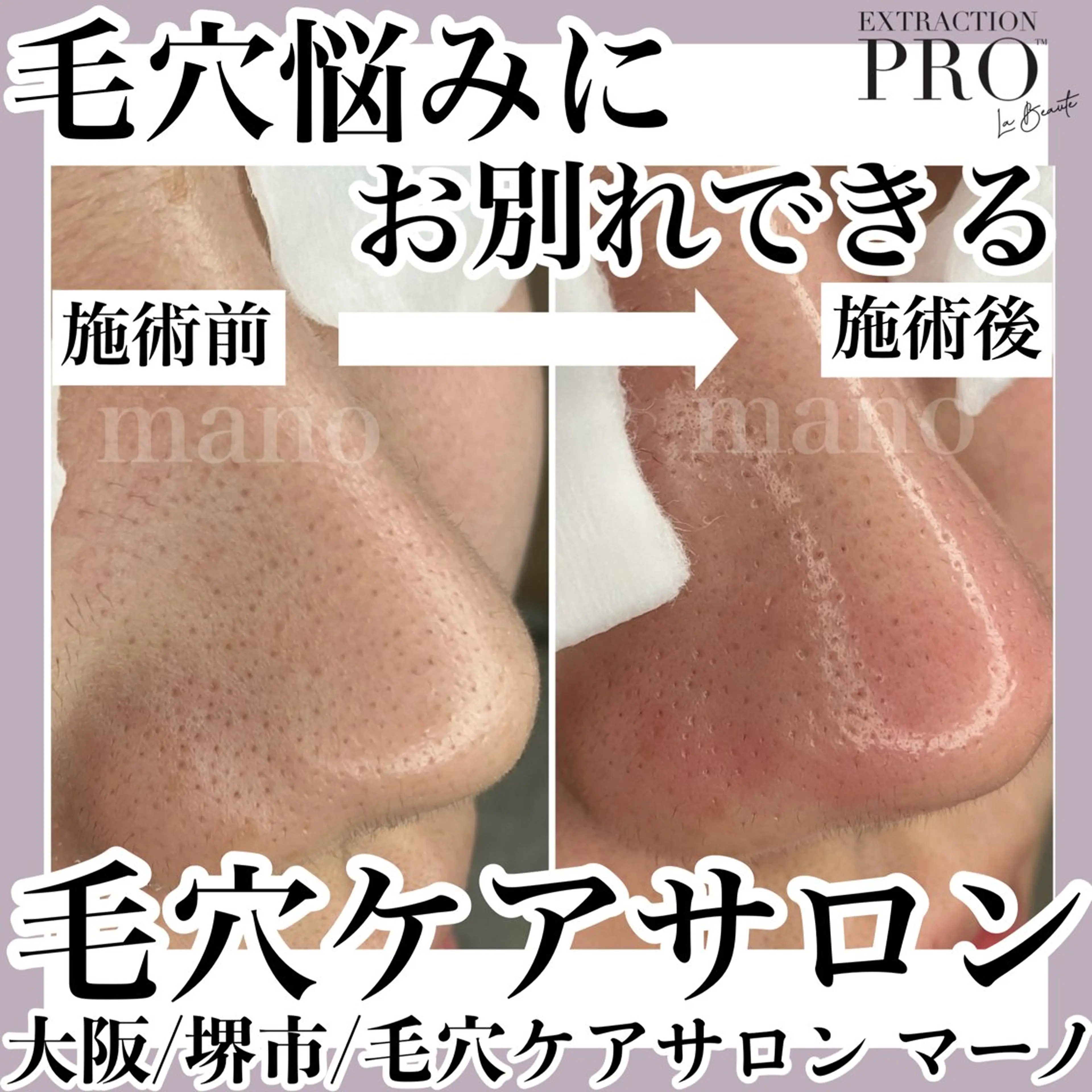 毛穴デコルテコース(毛穴エクストラクションプロあり)の写真