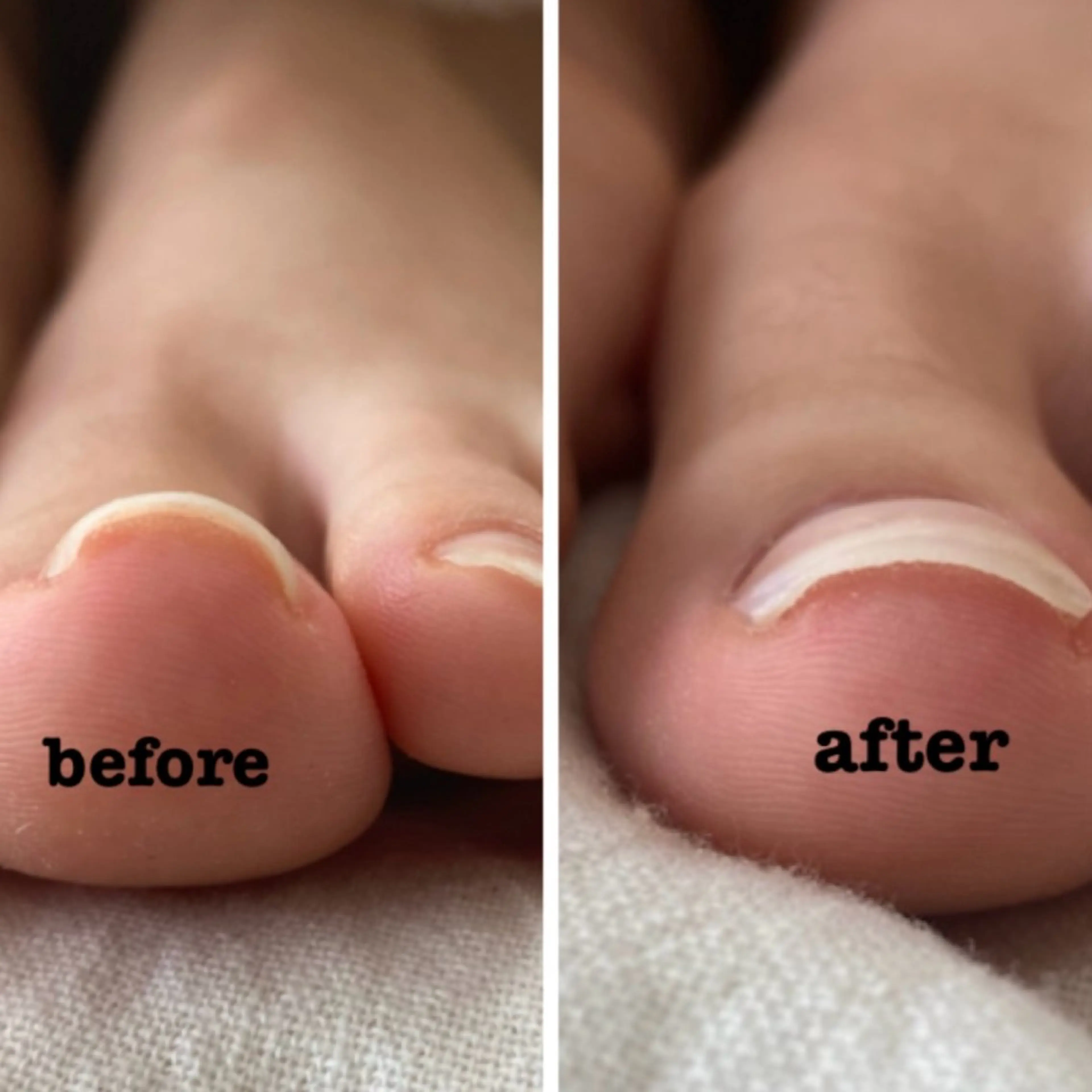 【FOOT】(オフなし)親指巻き爪ケア+ジェルワンカラーの写真