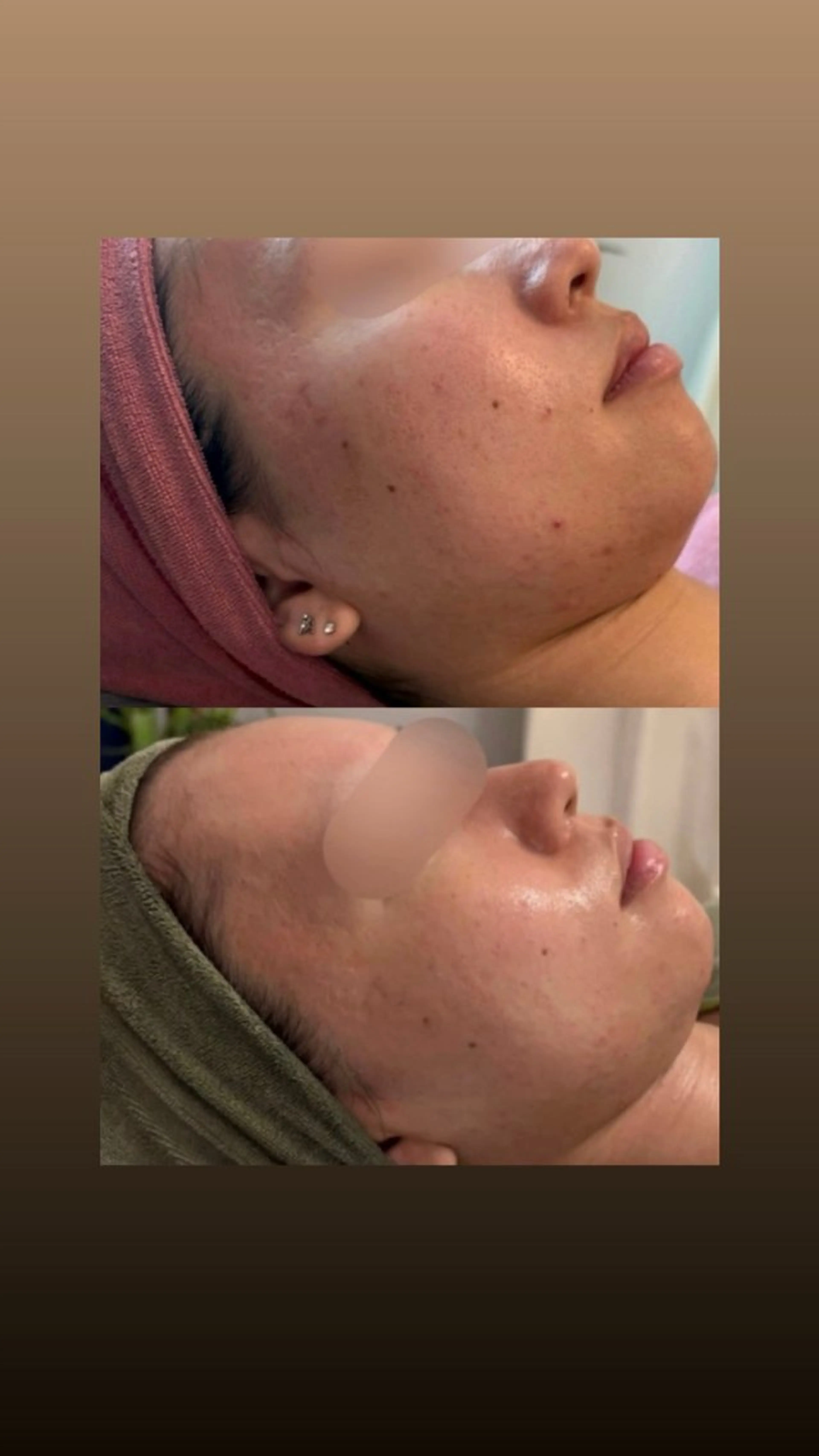 人気No.1🩶肌荒れ改善+小顔 InstagramへBefore Afterの投稿可の方(目元の配慮させていただきますの写真