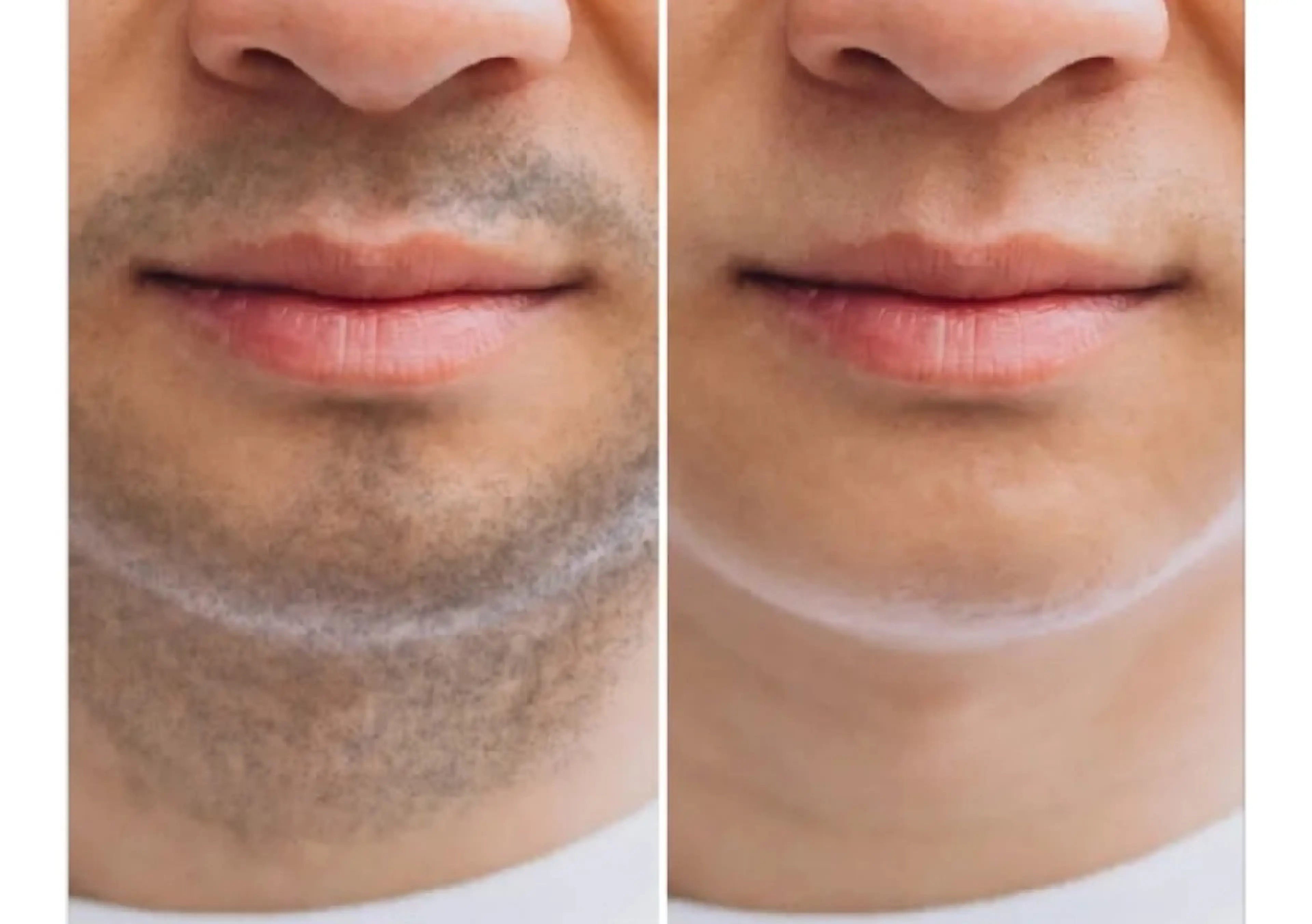 メンズ脱毛　最新LED全身丸投げ脱毛　[顔VIO込]　80分お顔のパックつきの写真