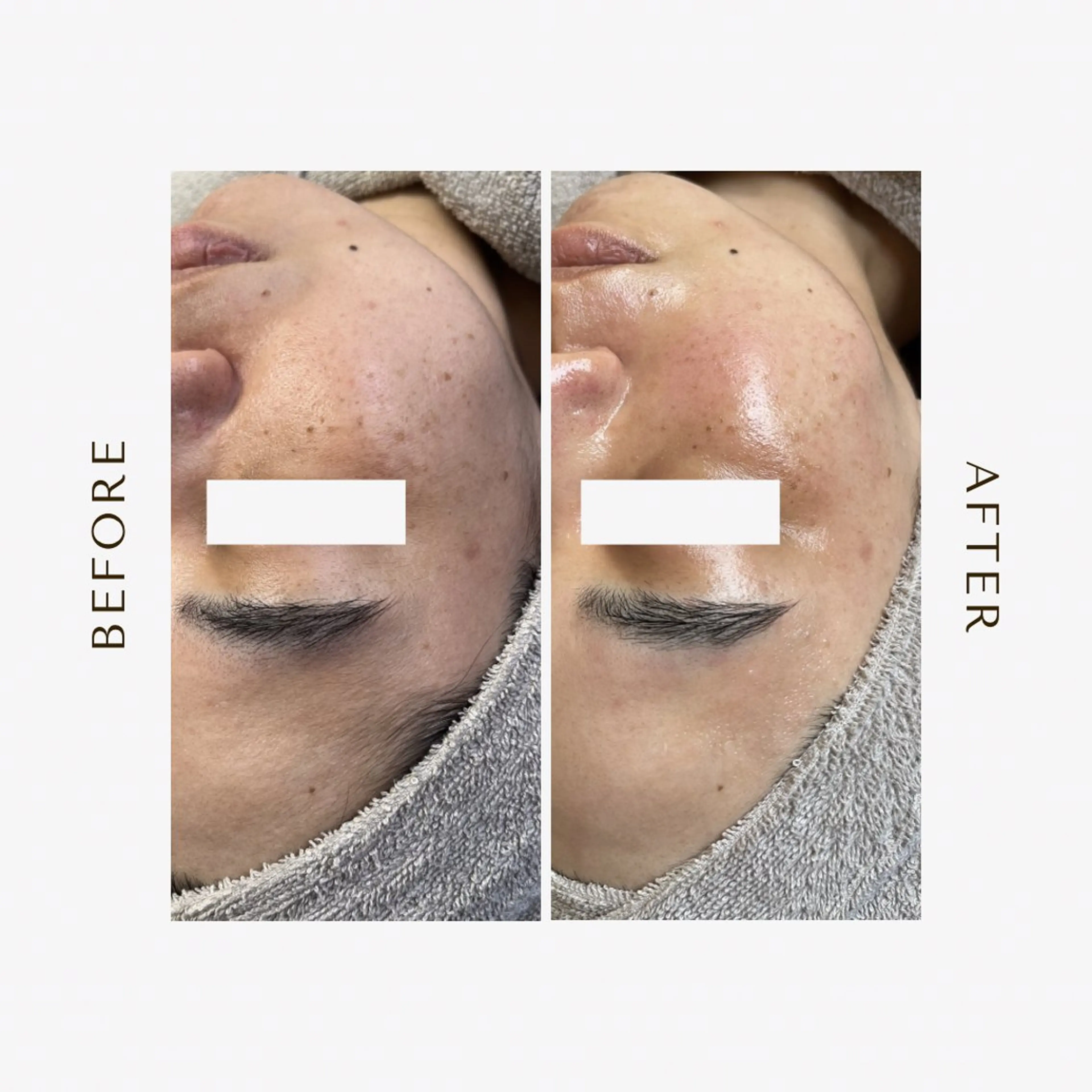 脱毛 1st｜フェイシャル エステ専門店のエステ・リラクイメージ