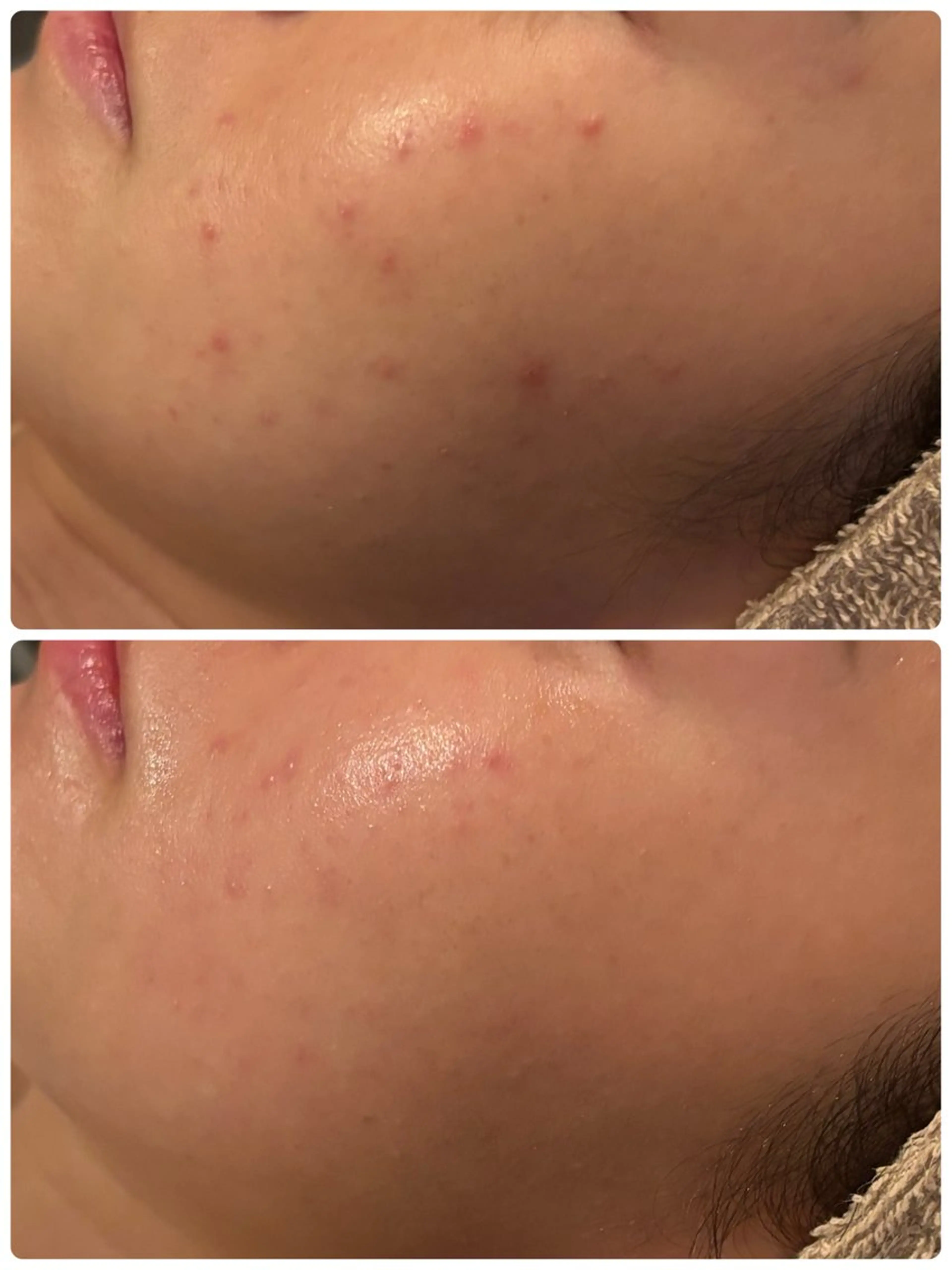 エステ 【リベルハーブピーリング認定店】敏感肌・美白脱毛専門店Dione立川店所属・Dione 立川店のエステ・リラクイメージ