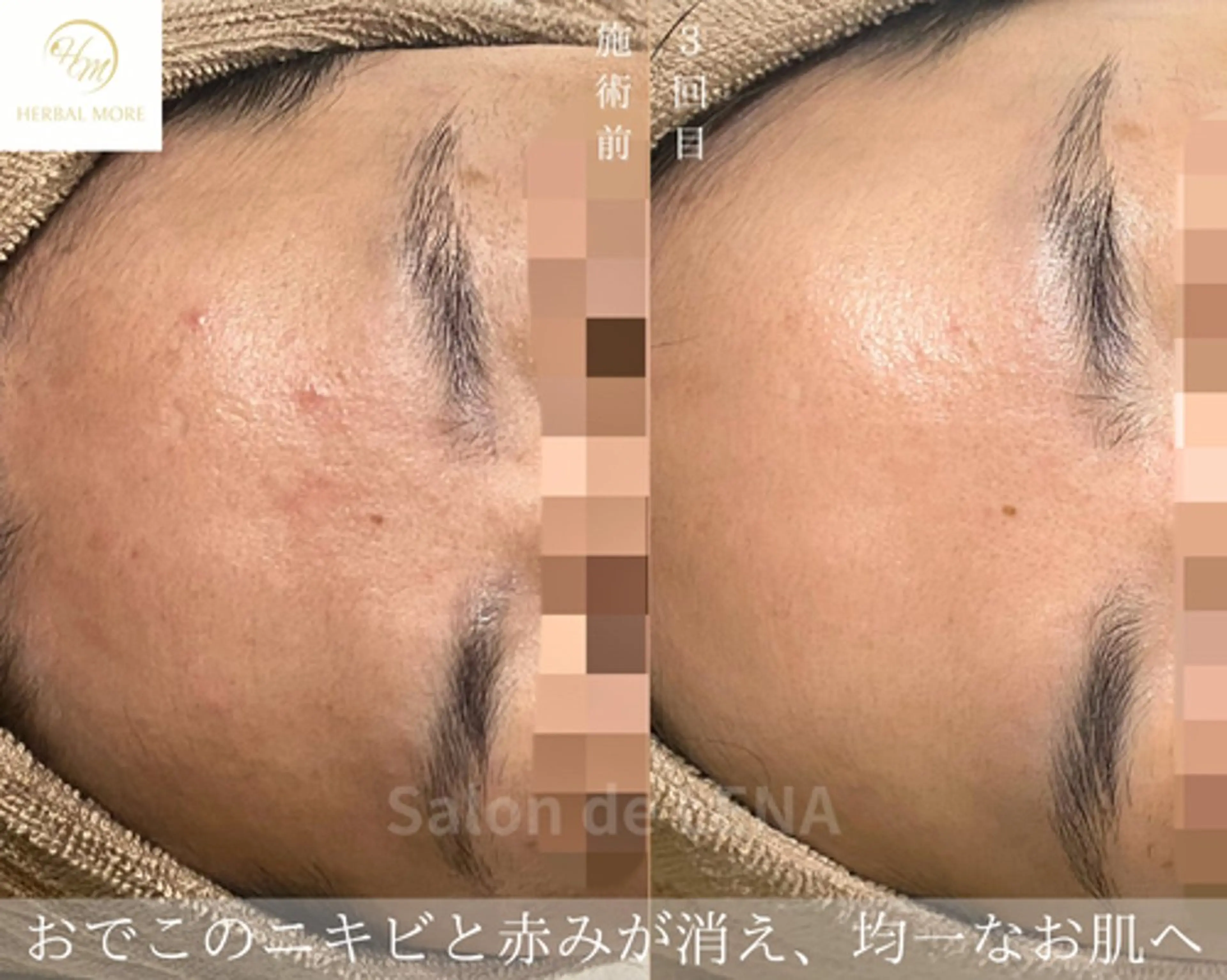 サロンドレナ名駅店所属・ハーブピーリング専門 サロンドレナ平岡のエステ・リラクイメージ