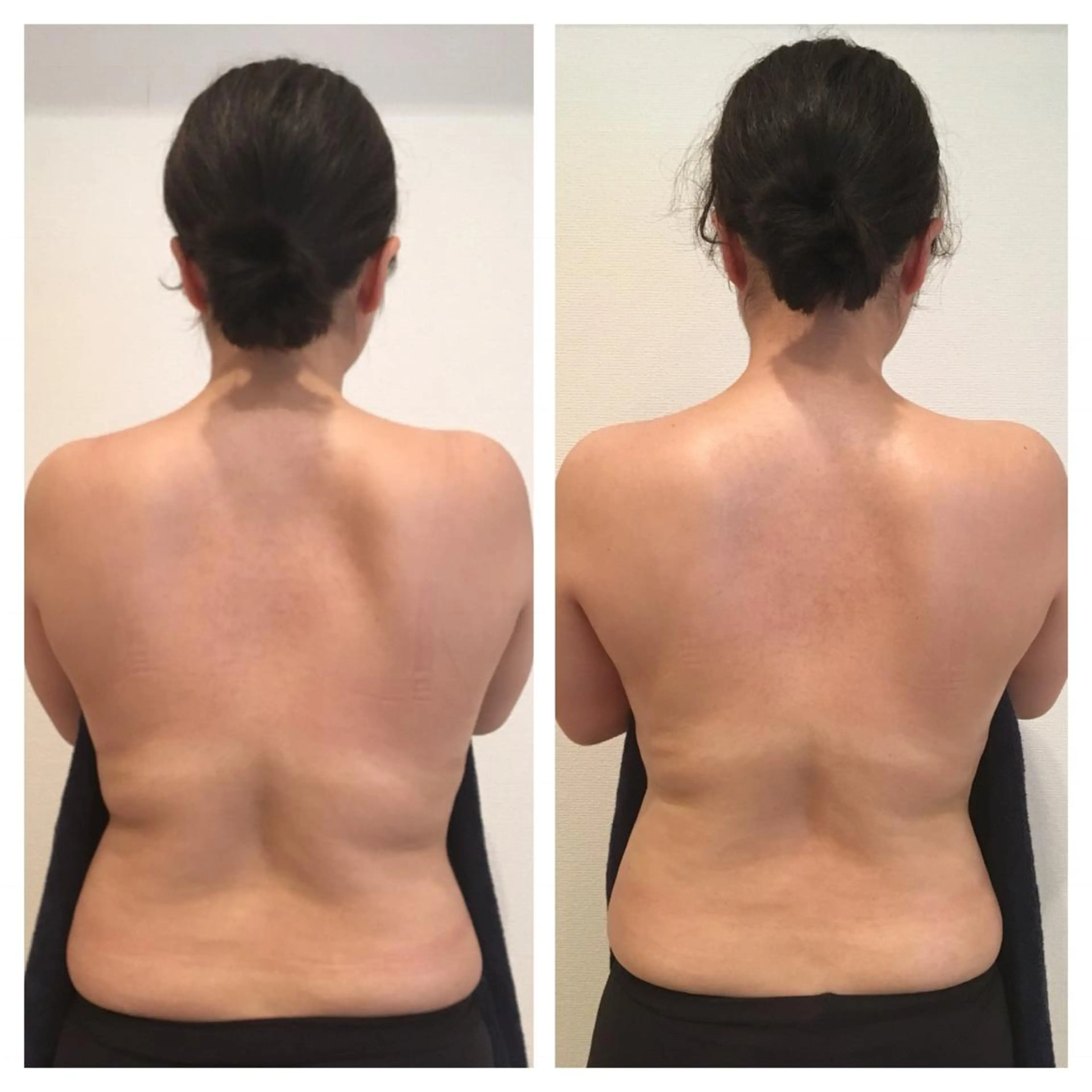 【キャビテーション】上半身ウエストケアコースの写真