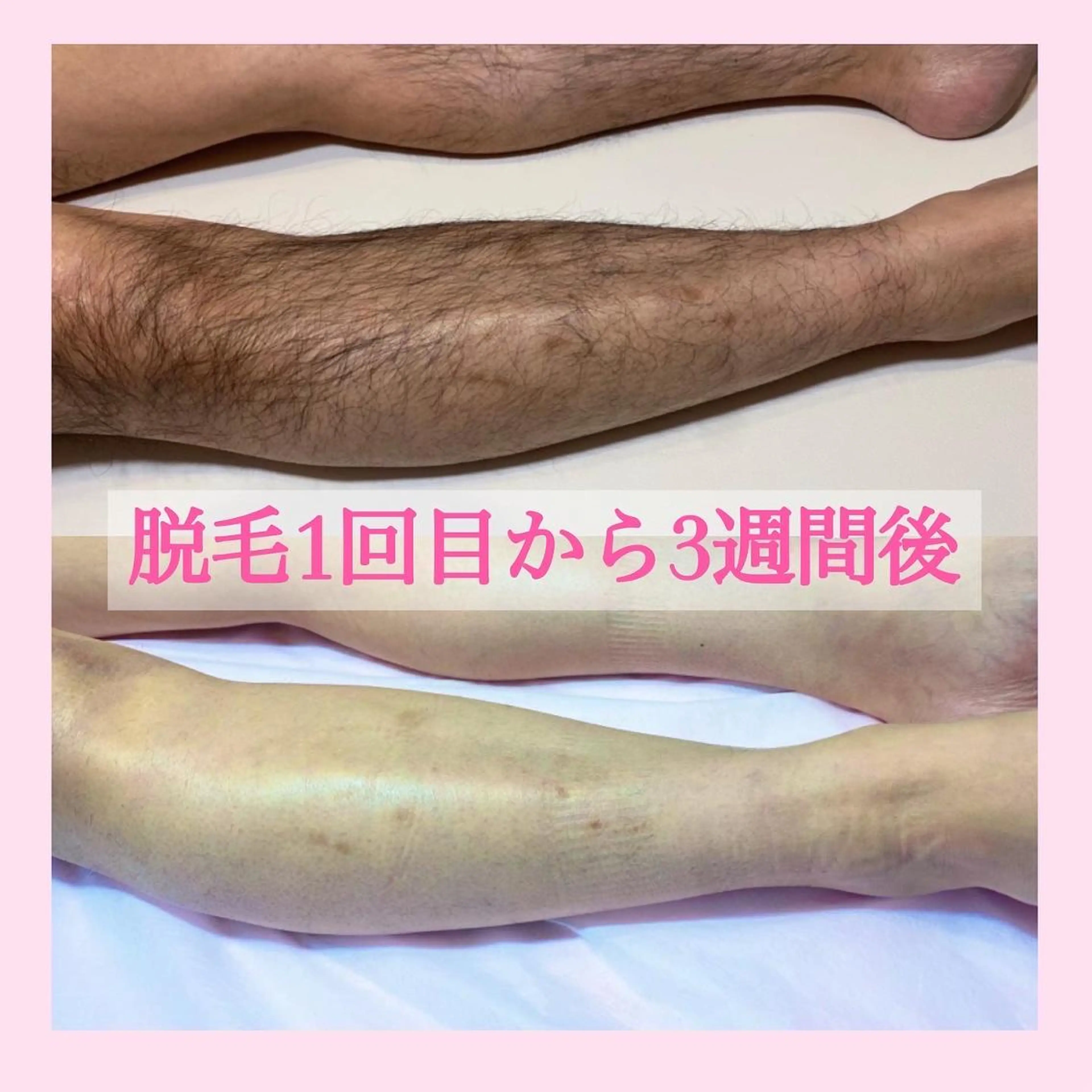 ❣キャンペーン中🌸次回予約で2回目も初回価格🌸メンズ脱毛】👨✨選べる膝下 or 肘下脱毛🔥薄くしたい方も❣の写真