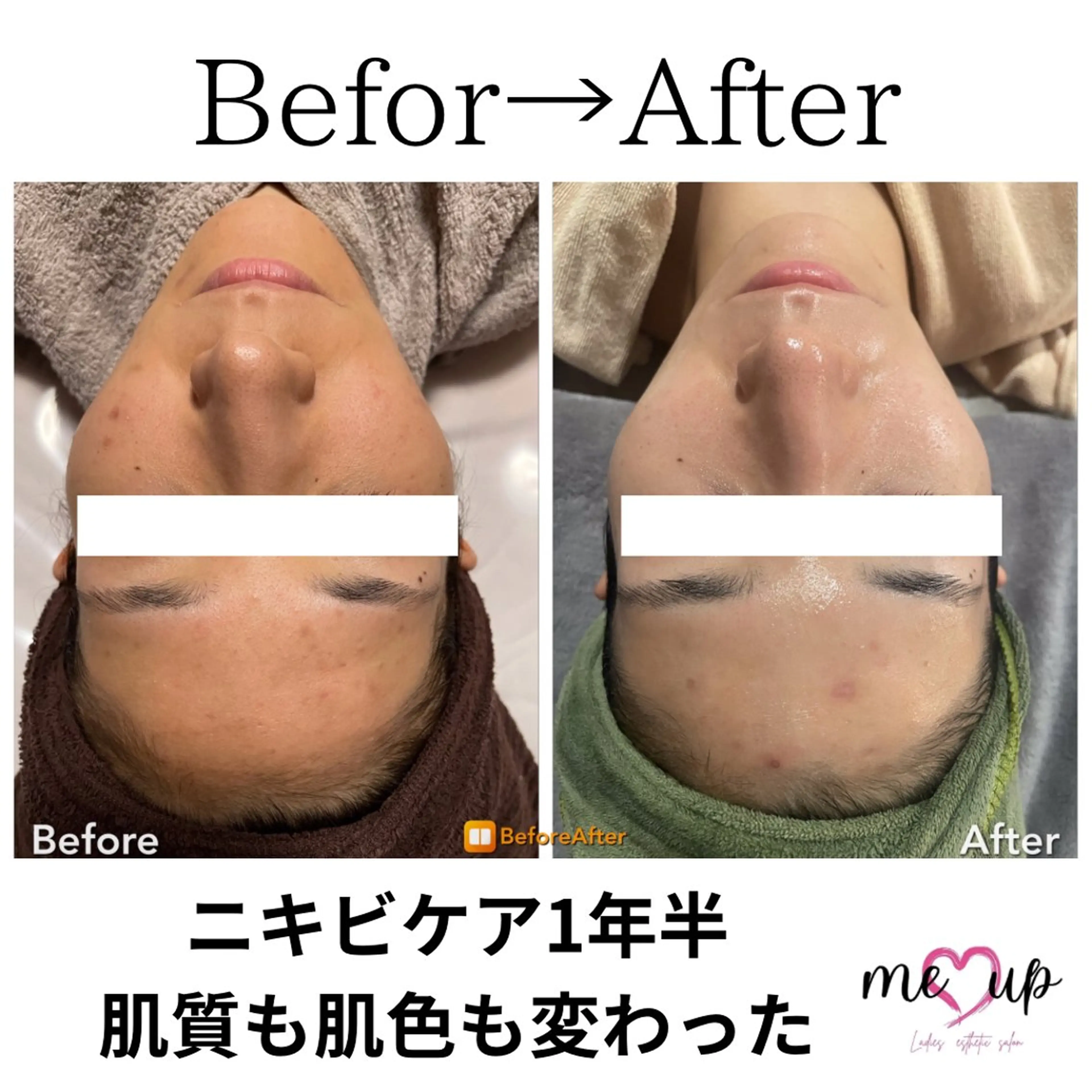 Meupニキビ専門店 背中/ハーブ/肌管理のその他イメージ