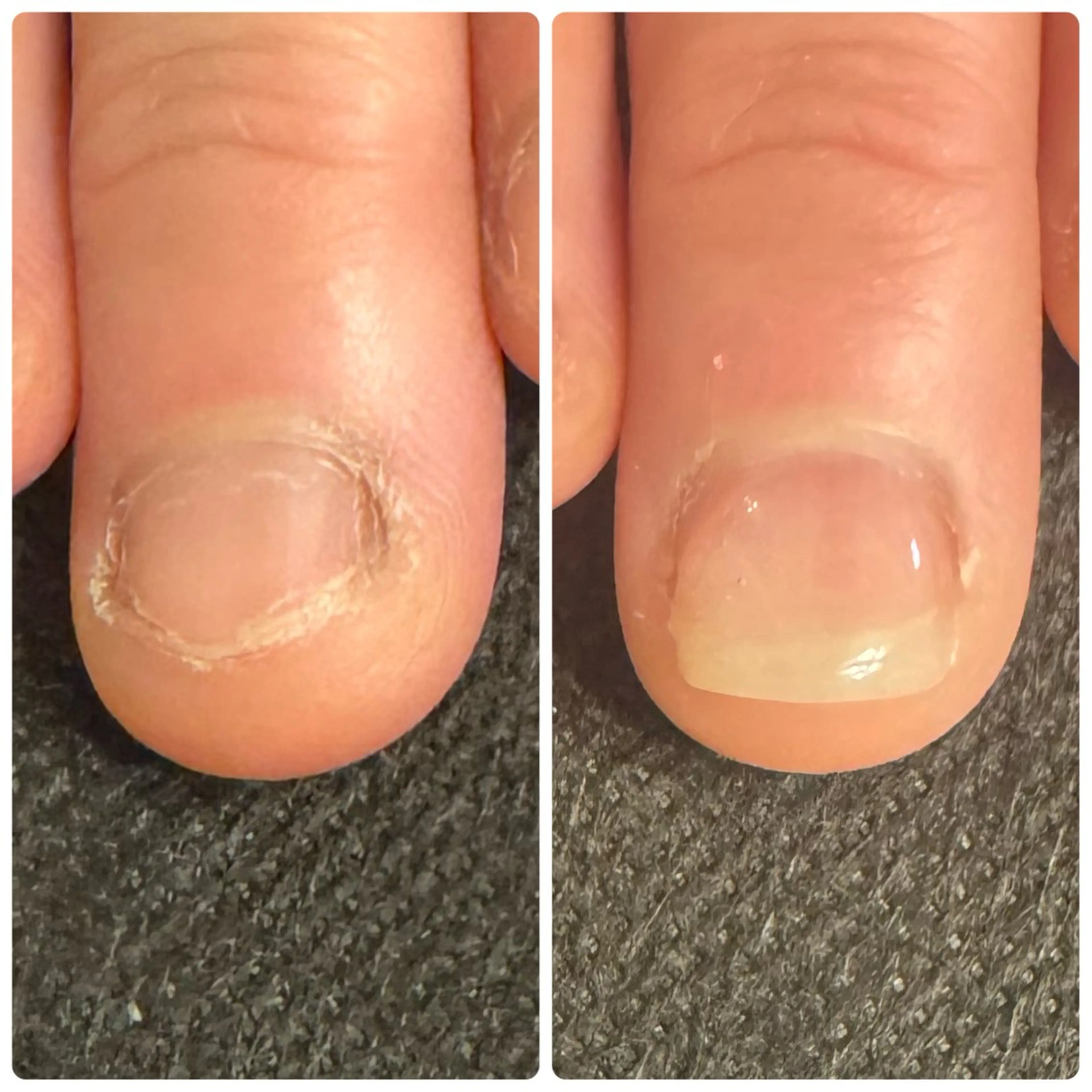 即日美爪形成コース　　　　　　　　　　　　　　　　　　　たった3時間で変わる深爪矯正の写真